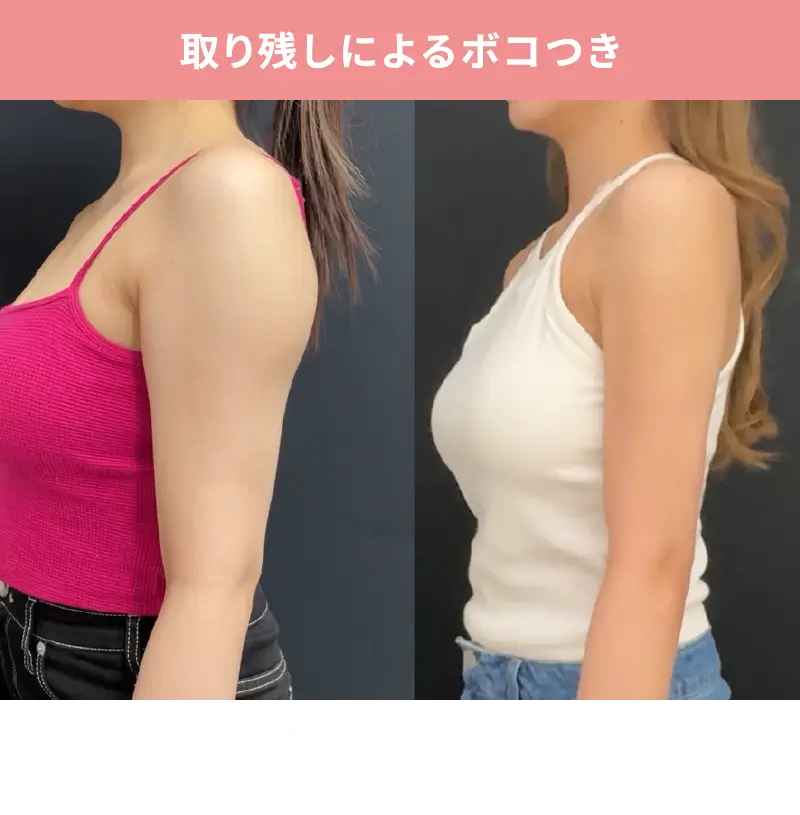 4D 修正参考02 取り残しによるボコつき