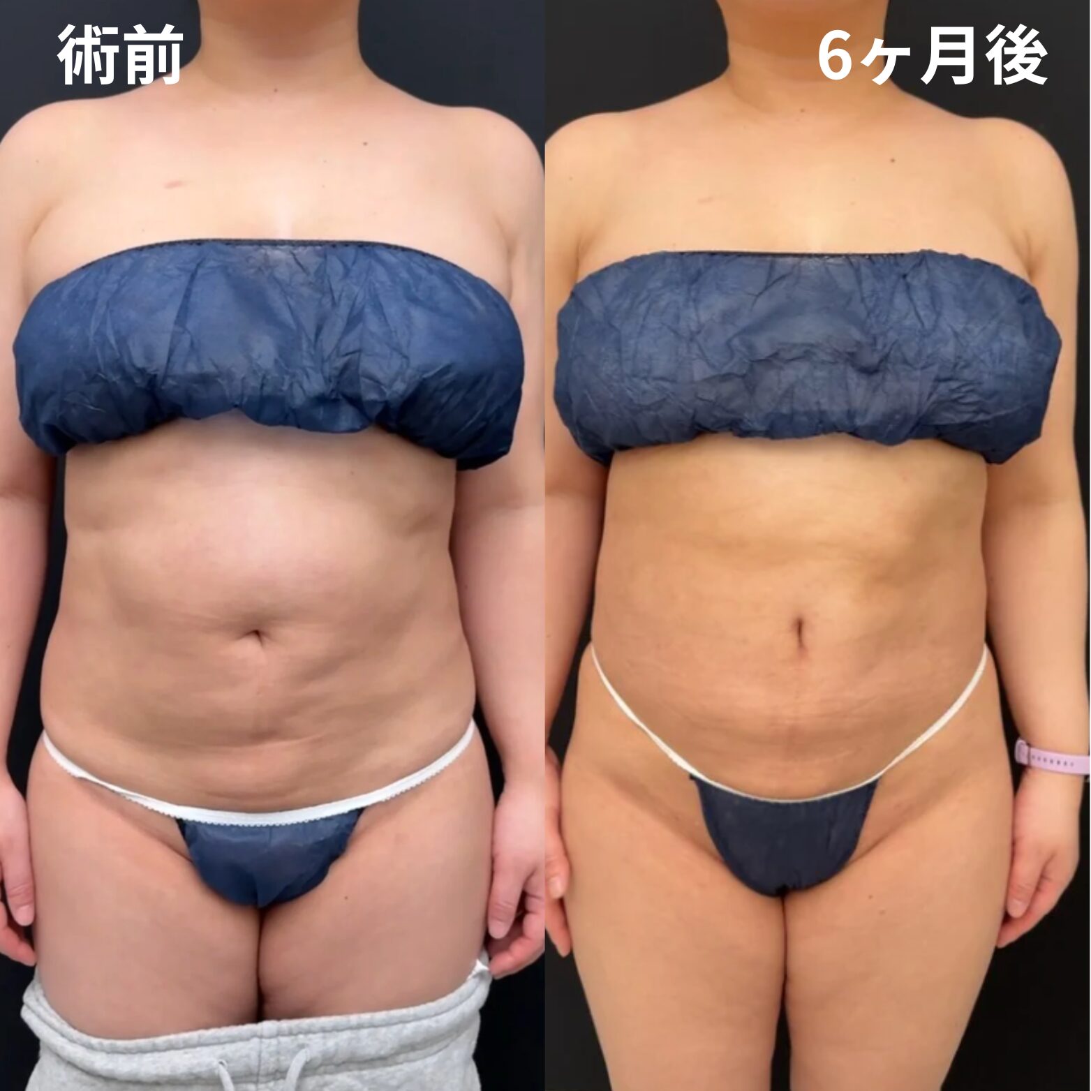 脂肪注入