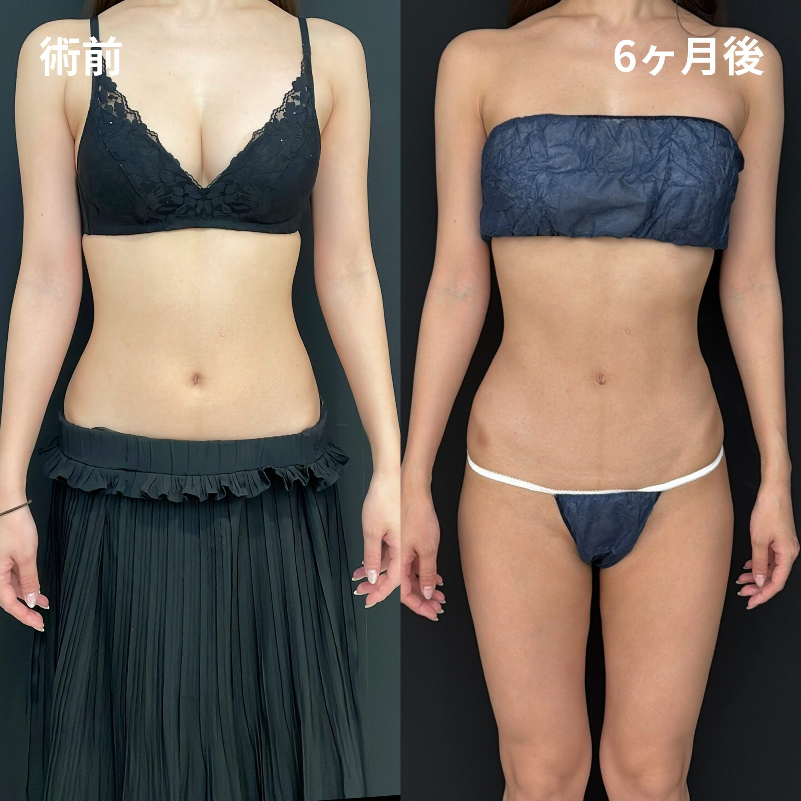 <br />
<b>Warning</b>:  Undefined variable $image_alt in <b>/home/r9092703/public_html/4dclinic.jp/wp/wp-content/themes/4d-clinic/single-case.php</b> on line <b>109</b><br />
