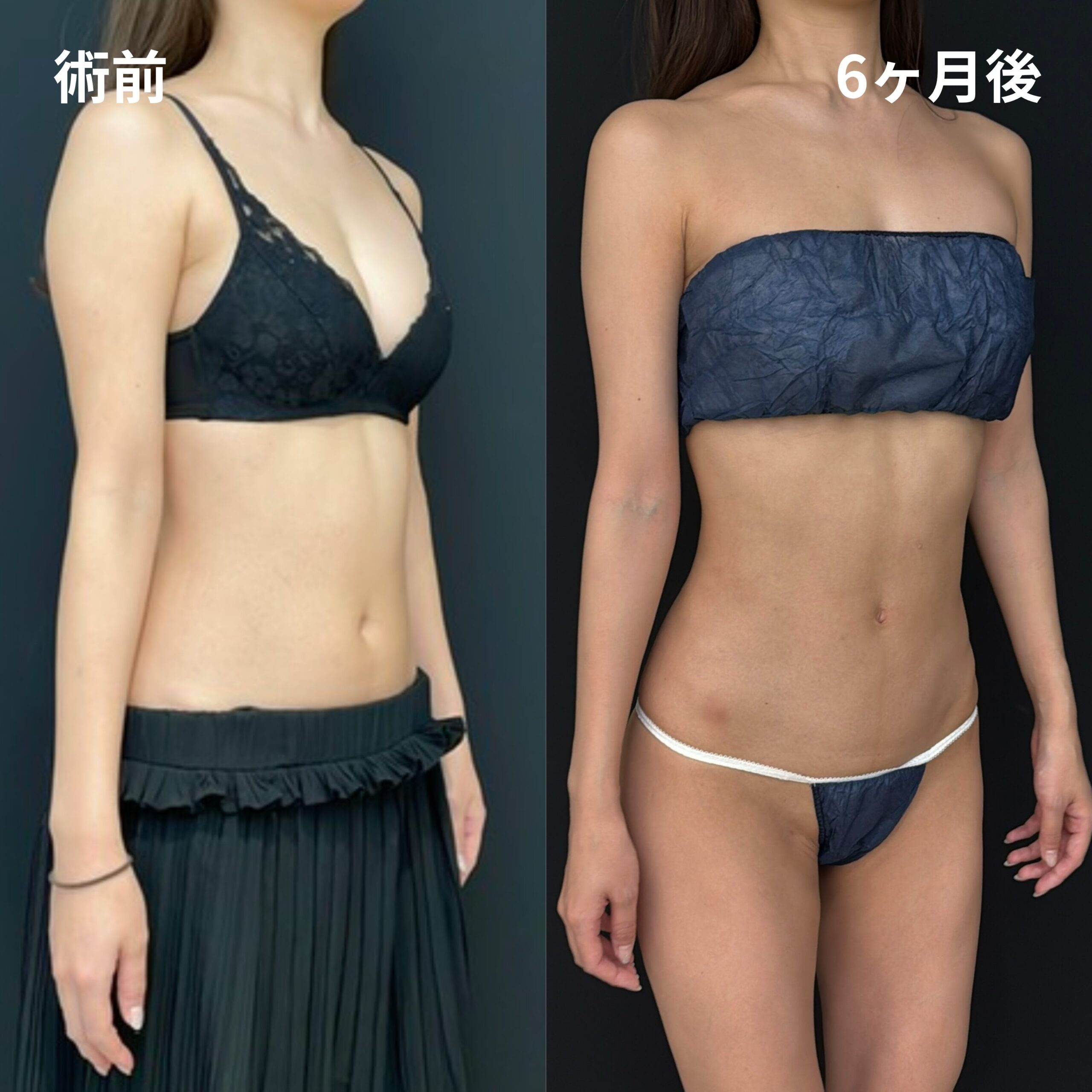 <br />
<b>Warning</b>:  Undefined variable $image_alt in <b>/home/r9092703/public_html/4dclinic.jp/wp/wp-content/themes/4d-clinic/single-case.php</b> on line <b>109</b><br />
