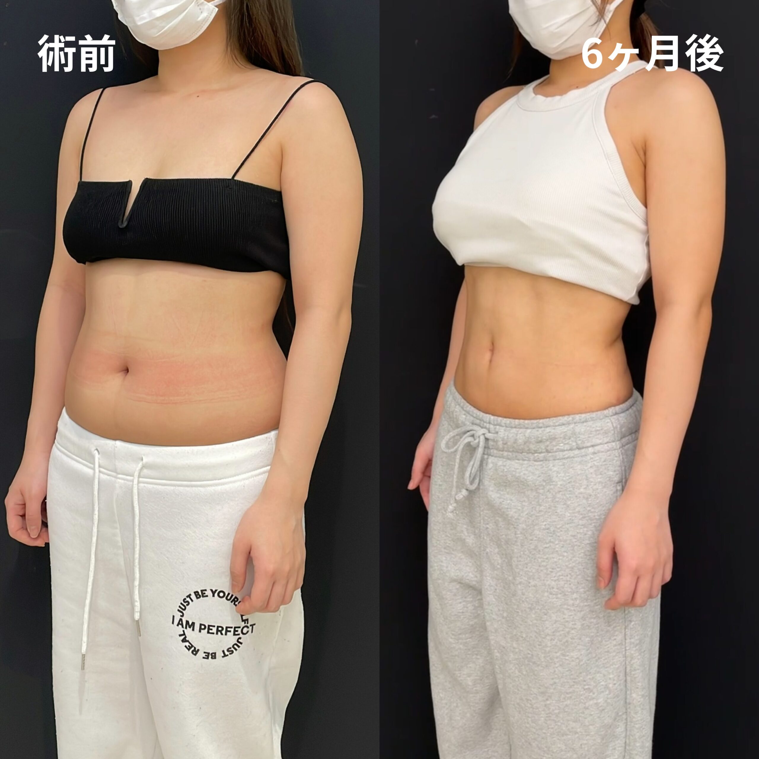 <br />
<b>Warning</b>:  Undefined variable $image_alt in <b>/home/r9092703/public_html/4dclinic.jp/wp/wp-content/themes/4d-clinic/single-case.php</b> on line <b>109</b><br />
