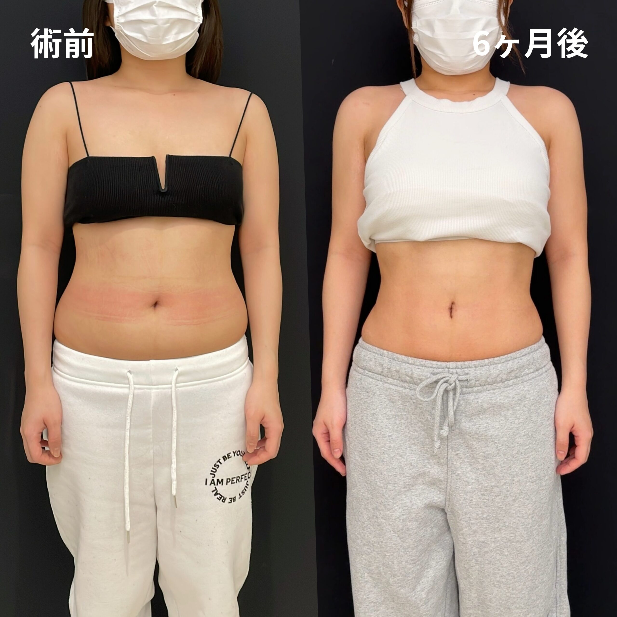 <br />
<b>Warning</b>:  Undefined variable $image_alt in <b>/home/r9092703/public_html/4dclinic.jp/wp/wp-content/themes/4d-clinic/single-case.php</b> on line <b>109</b><br />
