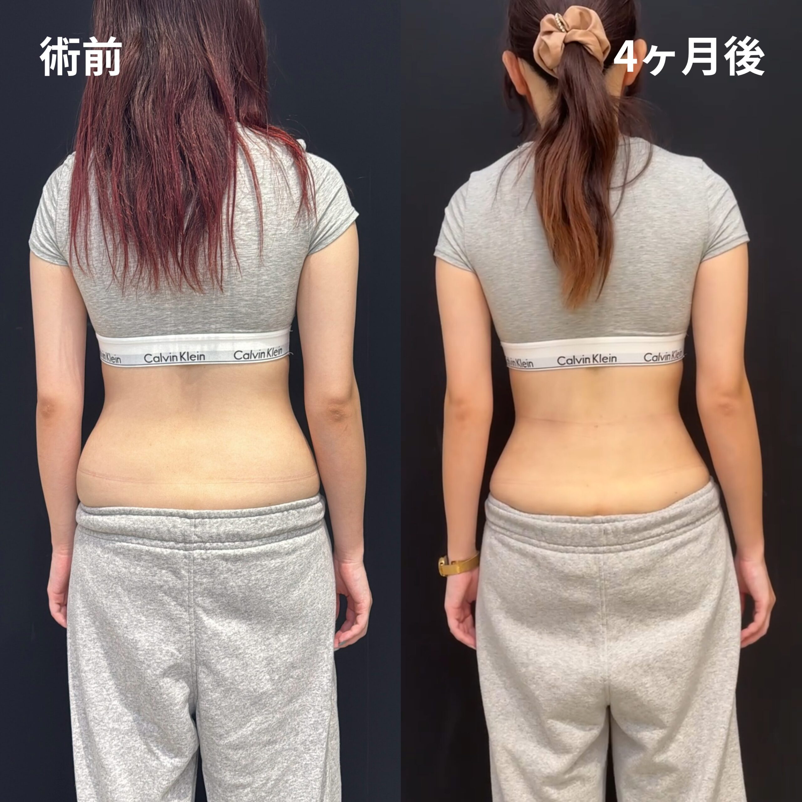 <br />
<b>Warning</b>:  Undefined variable $image_alt in <b>/home/r9092703/public_html/4dclinic.jp/wp/wp-content/themes/4d-clinic/single-case.php</b> on line <b>109</b><br />
