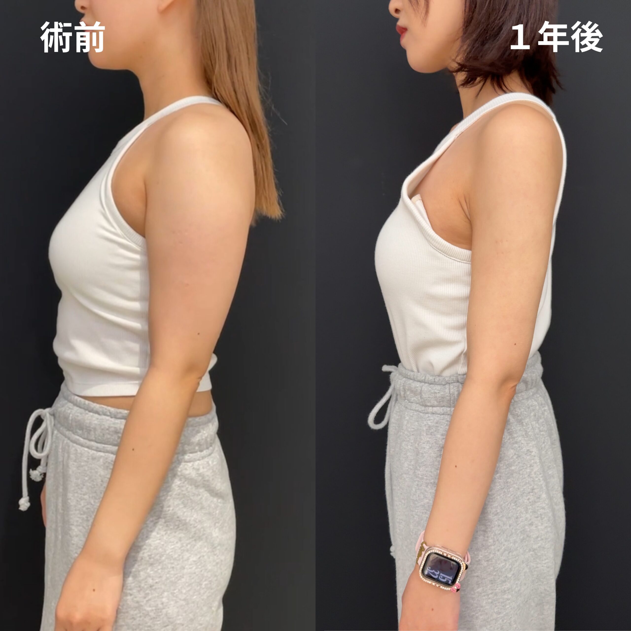 二の腕全周・肩・肩甲骨横・副乳脇肉