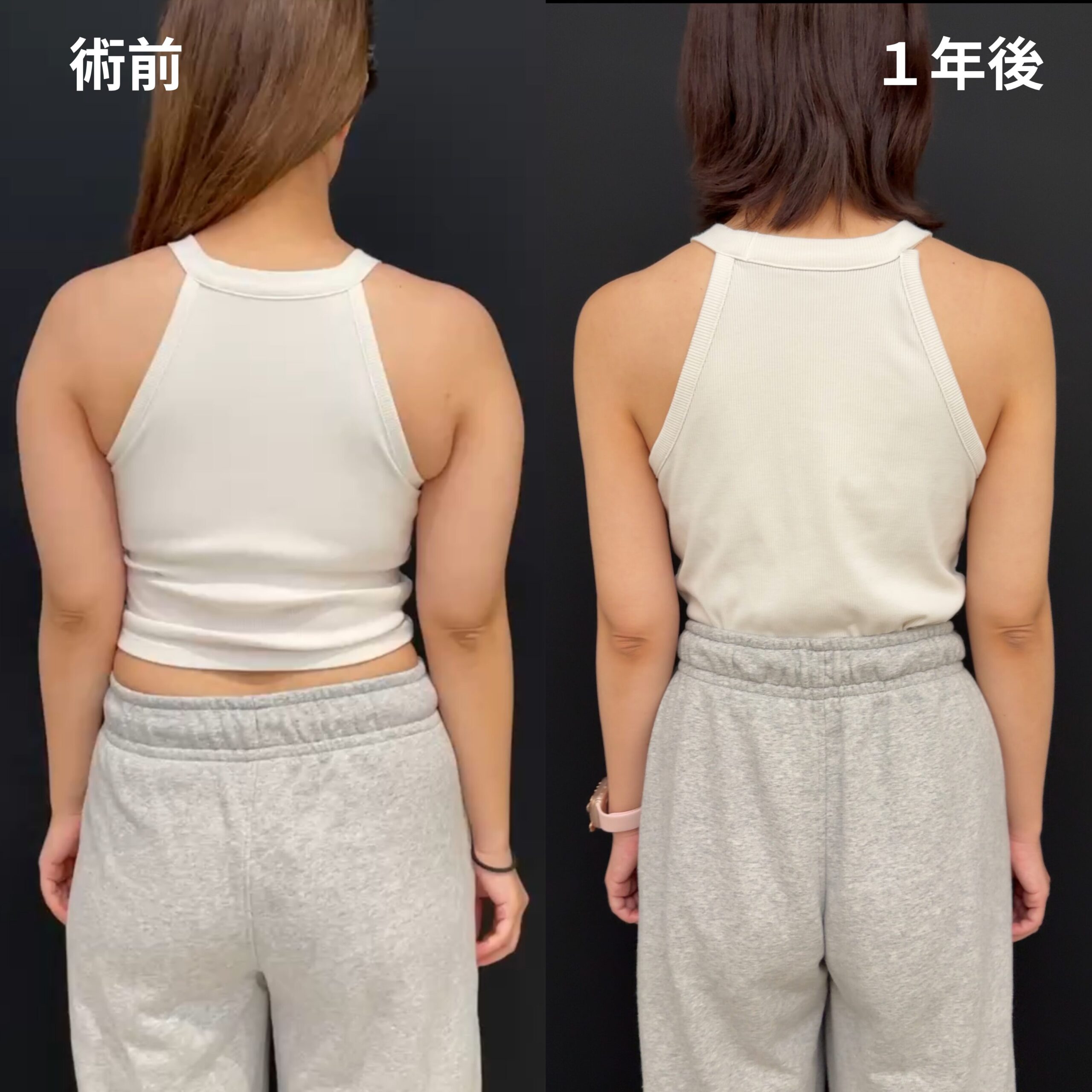 <br />
<b>Warning</b>:  Undefined variable $image_alt in <b>/home/r9092703/public_html/4dclinic.jp/wp/wp-content/themes/4d-clinic/single-case.php</b> on line <b>109</b><br />
