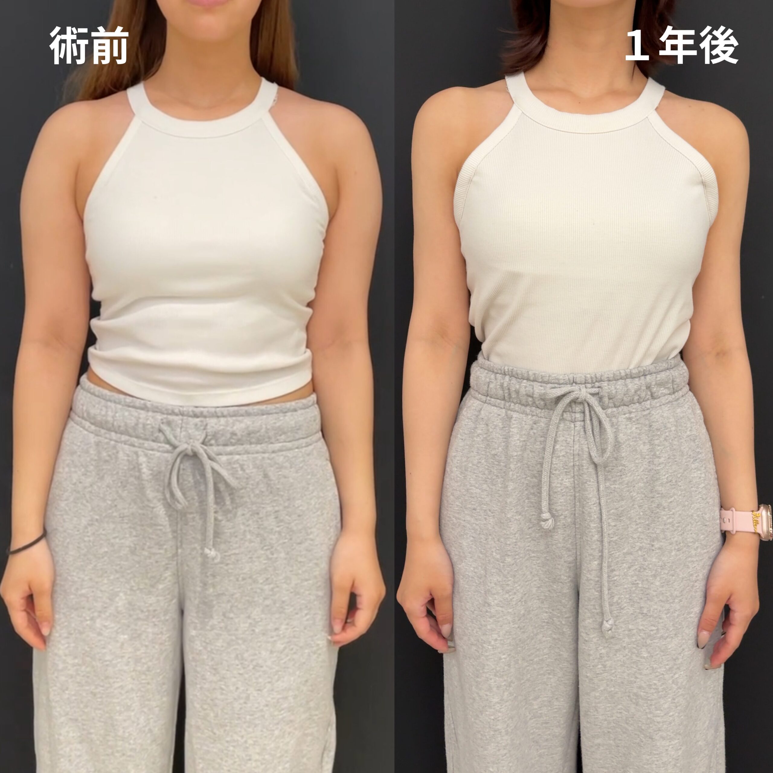 <br />
<b>Warning</b>:  Undefined variable $image_alt in <b>/home/r9092703/public_html/4dclinic.jp/wp/wp-content/themes/4d-clinic/single-case.php</b> on line <b>109</b><br />
