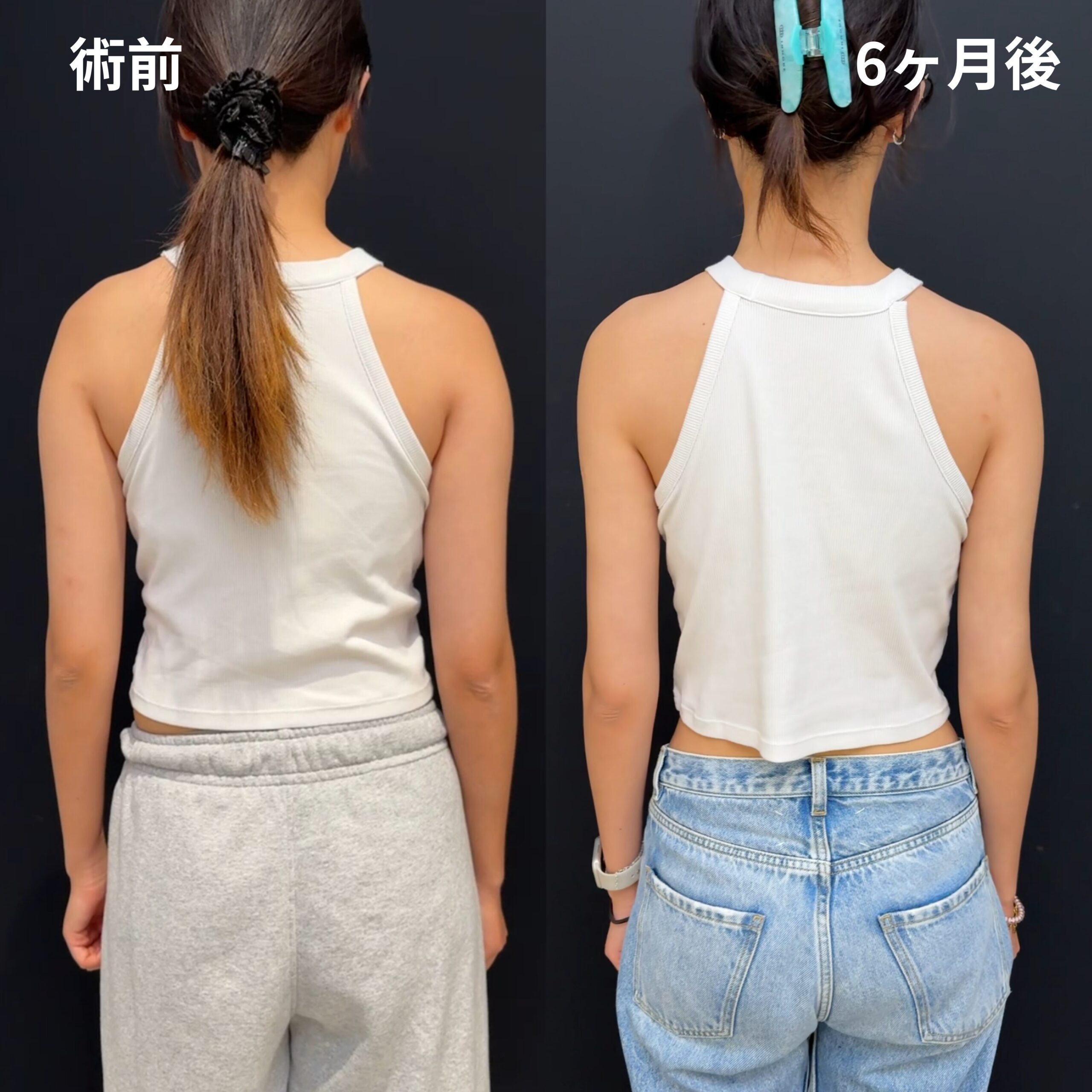 <br />
<b>Warning</b>:  Undefined variable $image_alt in <b>/home/r9092703/public_html/4dclinic.jp/wp/wp-content/themes/4d-clinic/single-case.php</b> on line <b>109</b><br />
