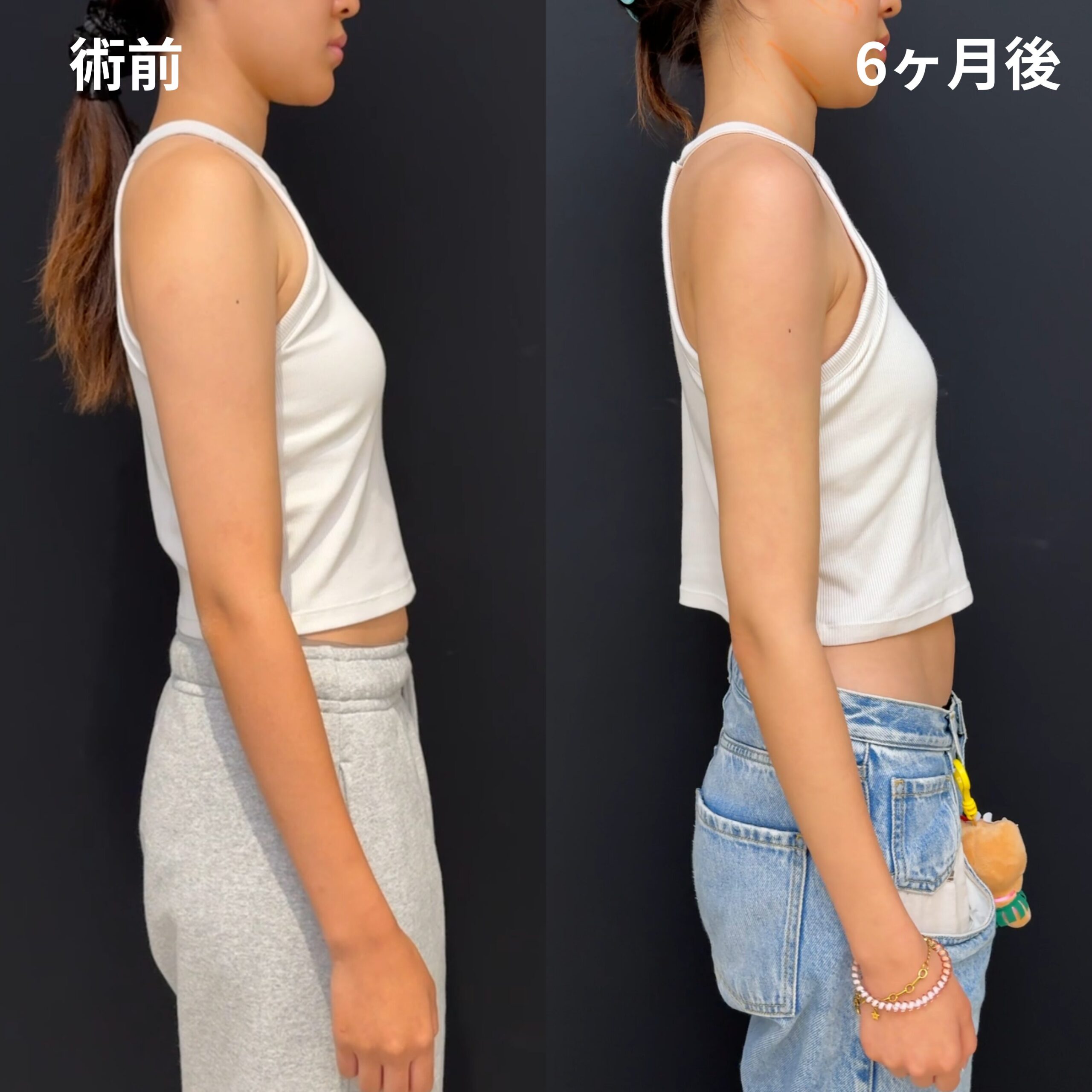 <br />
<b>Warning</b>:  Undefined variable $image_alt in <b>/home/r9092703/public_html/4dclinic.jp/wp/wp-content/themes/4d-clinic/single-case.php</b> on line <b>109</b><br />
