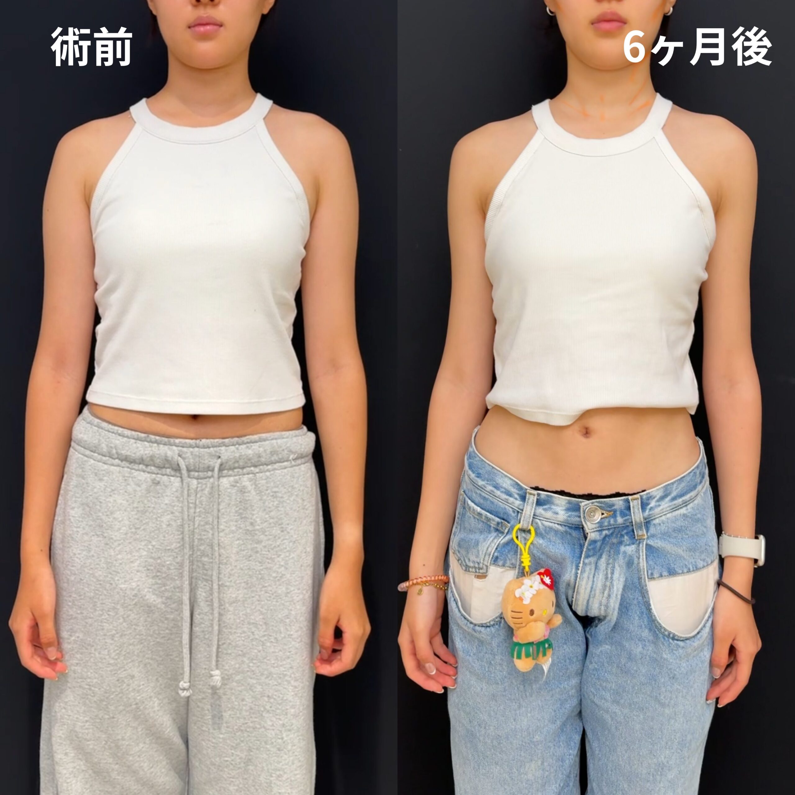 <br />
<b>Warning</b>:  Undefined variable $image_alt in <b>/home/r9092703/public_html/4dclinic.jp/wp/wp-content/themes/4d-clinic/single-case.php</b> on line <b>109</b><br />
