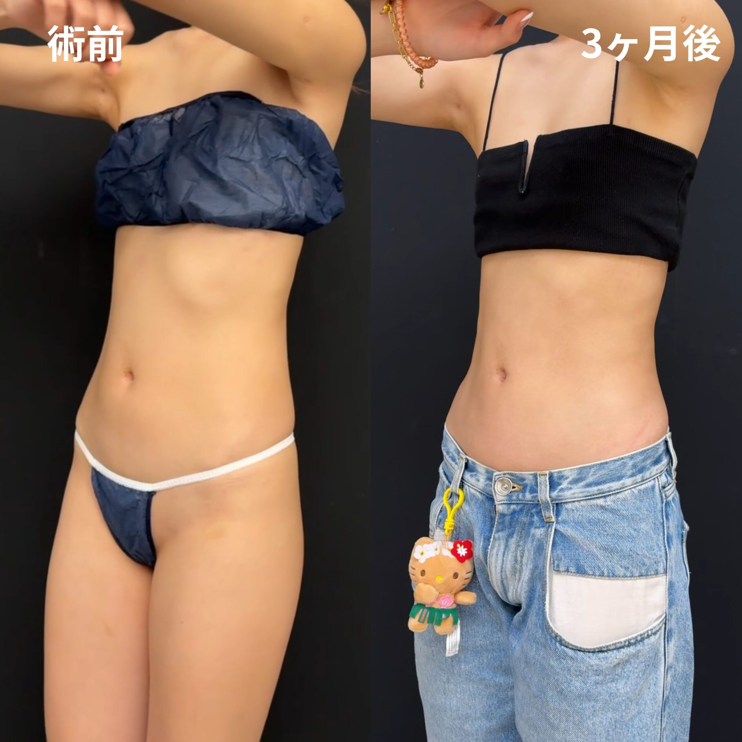 <br />
<b>Warning</b>:  Undefined variable $image_alt in <b>/home/r9092703/public_html/4dclinic.jp/wp/wp-content/themes/4d-clinic/single-case.php</b> on line <b>109</b><br />
