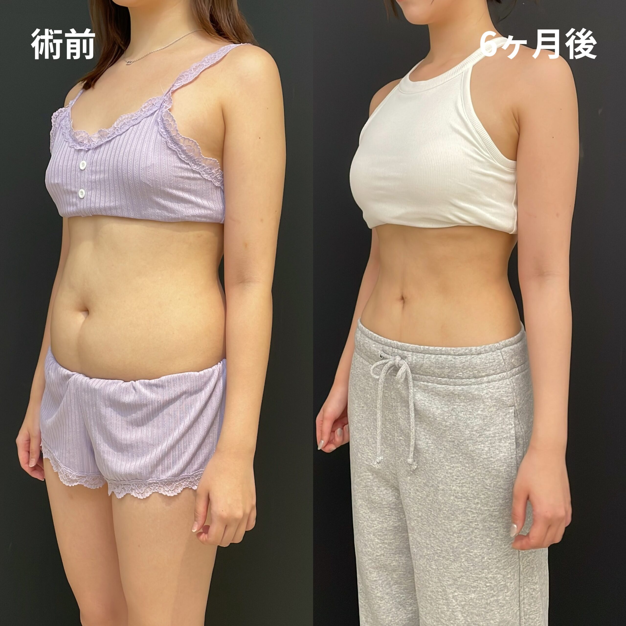 <br />
<b>Warning</b>:  Undefined variable $image_alt in <b>/home/r9092703/public_html/4dclinic.jp/wp/wp-content/themes/4d-clinic/single-case.php</b> on line <b>109</b><br />

