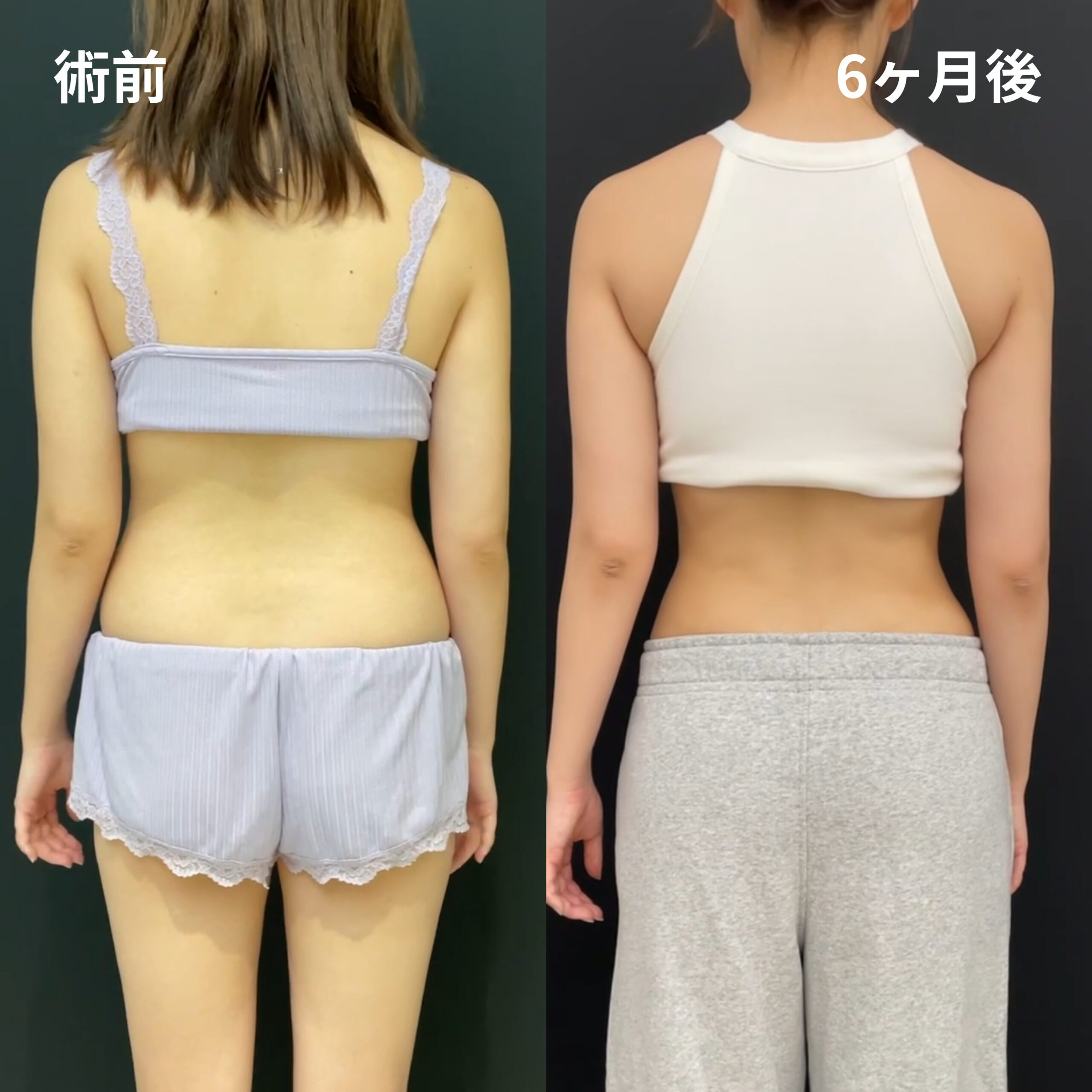 <br />
<b>Warning</b>:  Undefined variable $image_alt in <b>/home/r9092703/public_html/4dclinic.jp/wp/wp-content/themes/4d-clinic/single-case.php</b> on line <b>109</b><br />
