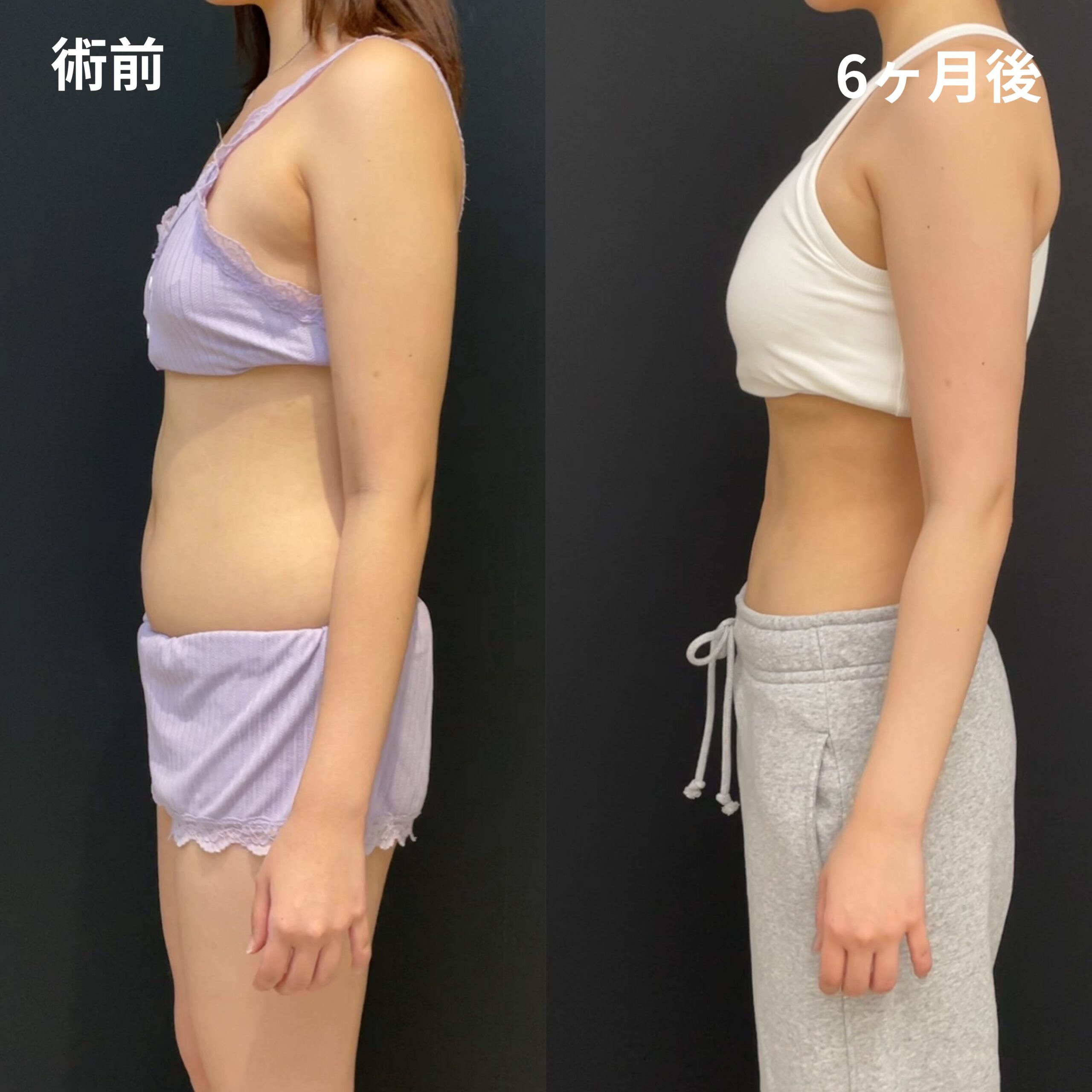 <br />
<b>Warning</b>:  Undefined variable $image_alt in <b>/home/r9092703/public_html/4dclinic.jp/wp/wp-content/themes/4d-clinic/single-case.php</b> on line <b>109</b><br />
