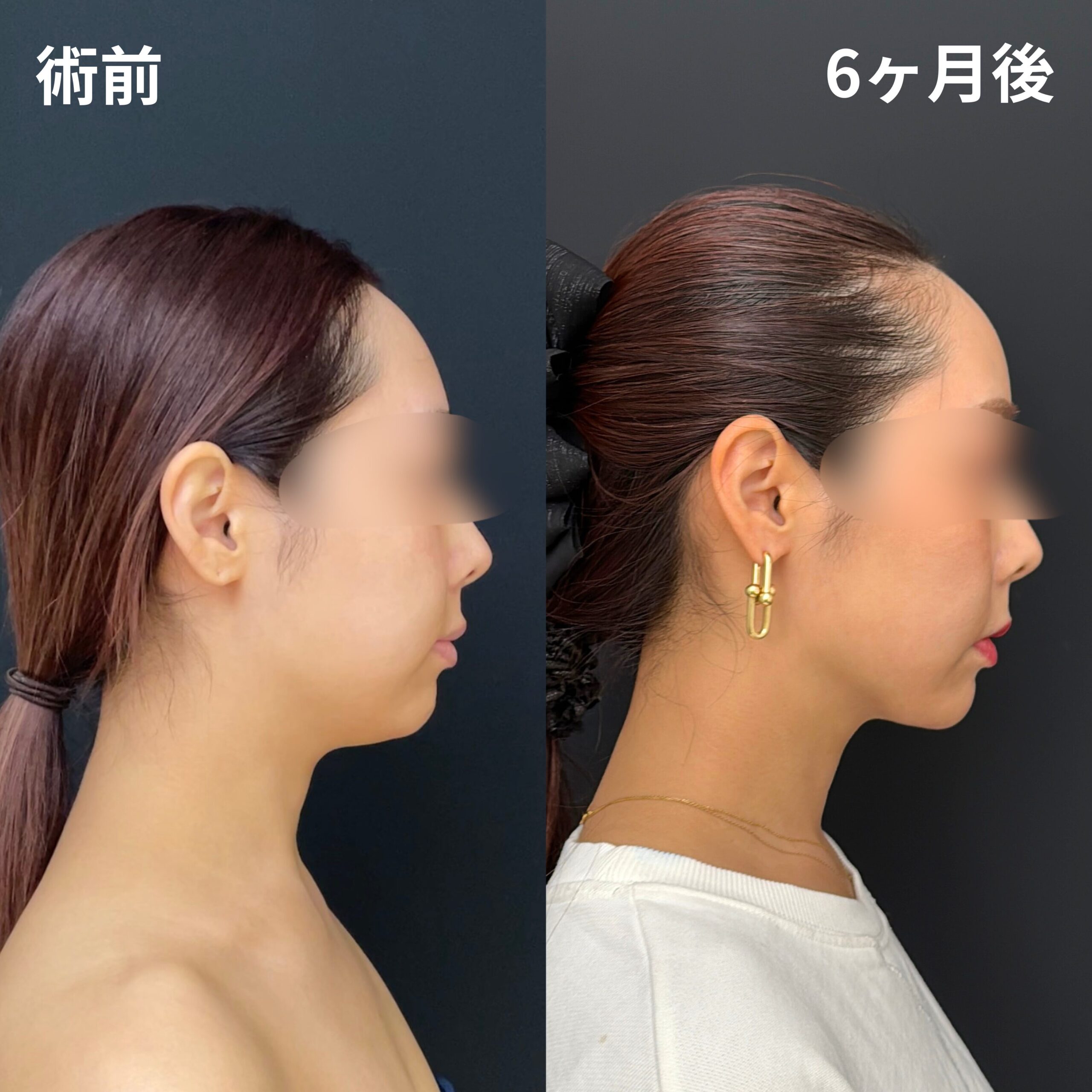 <br />
<b>Warning</b>:  Undefined variable $image_alt in <b>/home/r9092703/public_html/4dclinic.jp/wp/wp-content/themes/4d-clinic/single-case.php</b> on line <b>109</b><br />
