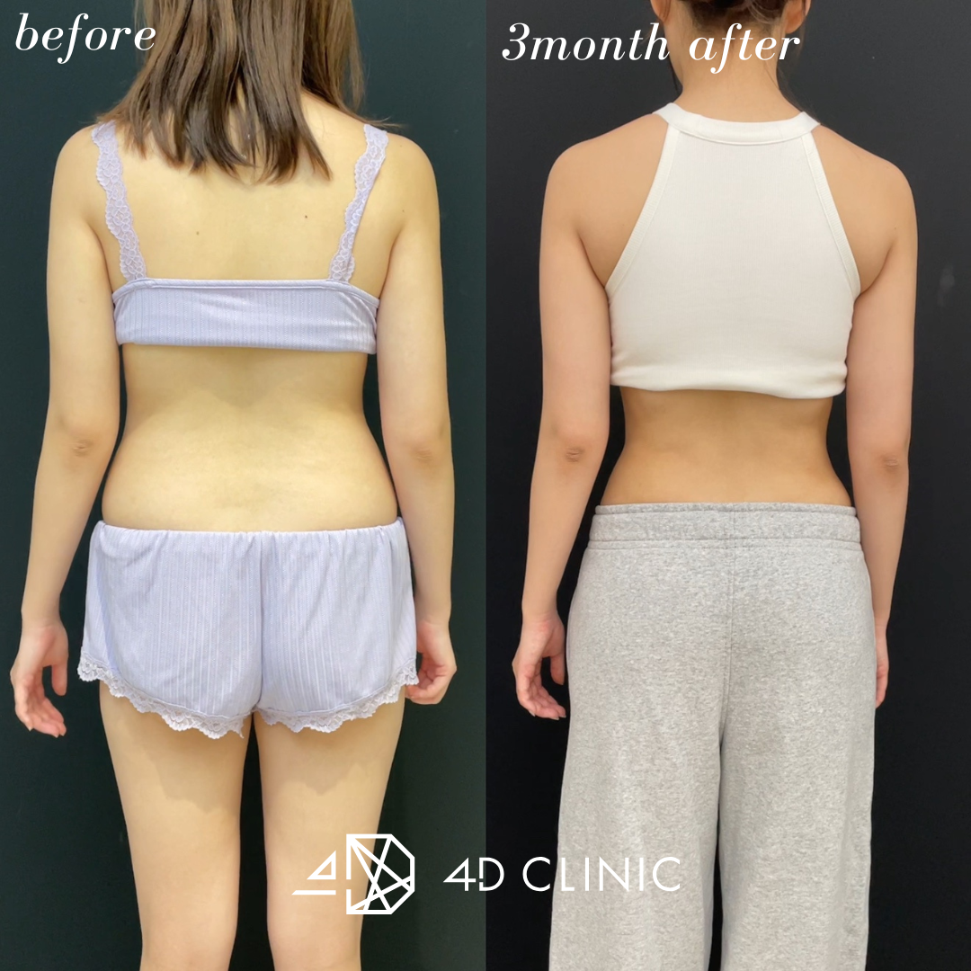 <br />
<b>Warning</b>:  Undefined variable $image_alt in <b>/home/r9092703/public_html/4dclinic.jp/wp/wp-content/themes/4d-clinic/single-case.php</b> on line <b>108</b><br />
