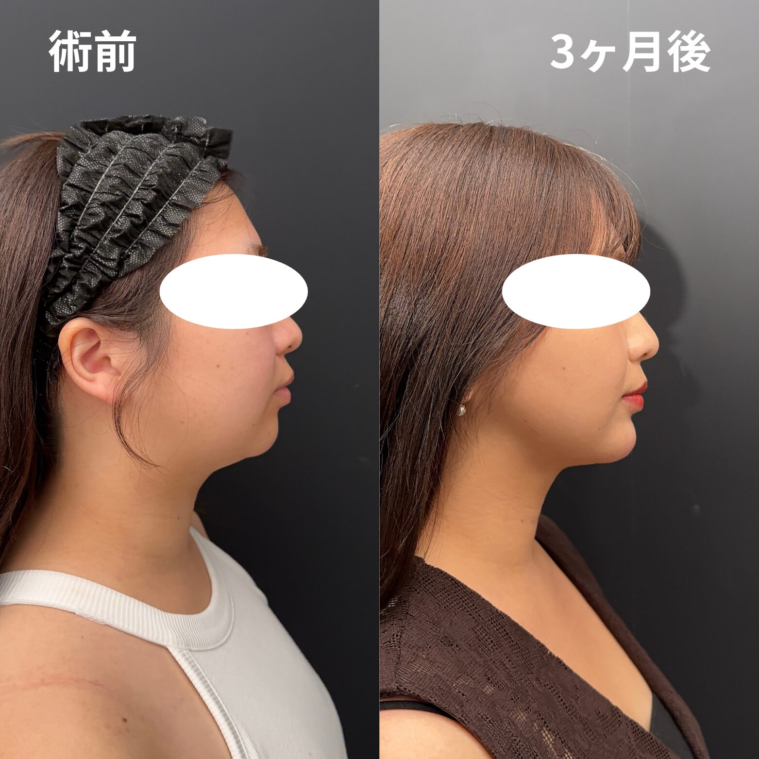 <br />
<b>Warning</b>:  Undefined variable $image_alt in <b>/home/r9092703/public_html/4dclinic.jp/wp/wp-content/themes/4d-clinic/single-case.php</b> on line <b>109</b><br />
