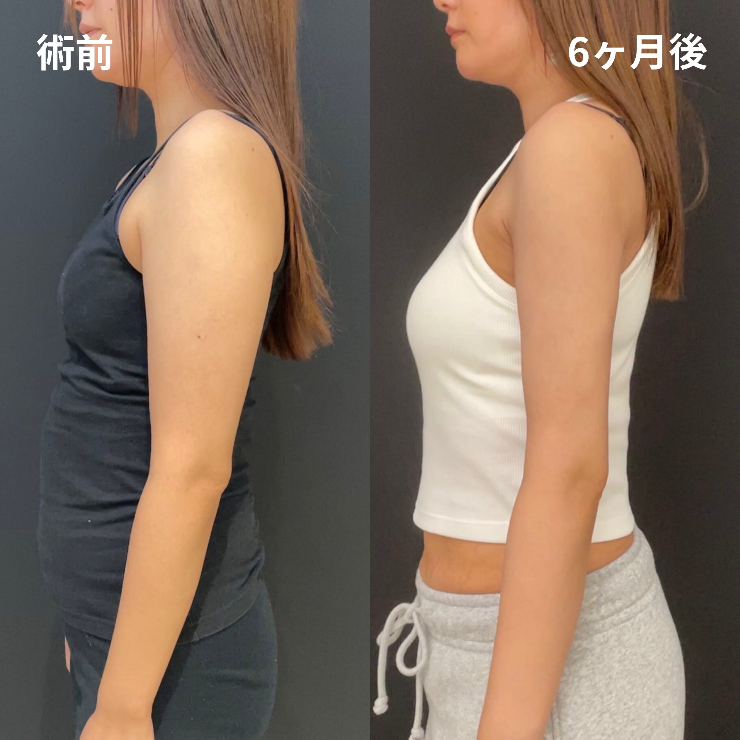 <br />
<b>Warning</b>:  Undefined variable $image_alt in <b>/home/r9092703/public_html/4dclinic.jp/wp/wp-content/themes/4d-clinic/single-case.php</b> on line <b>109</b><br />
