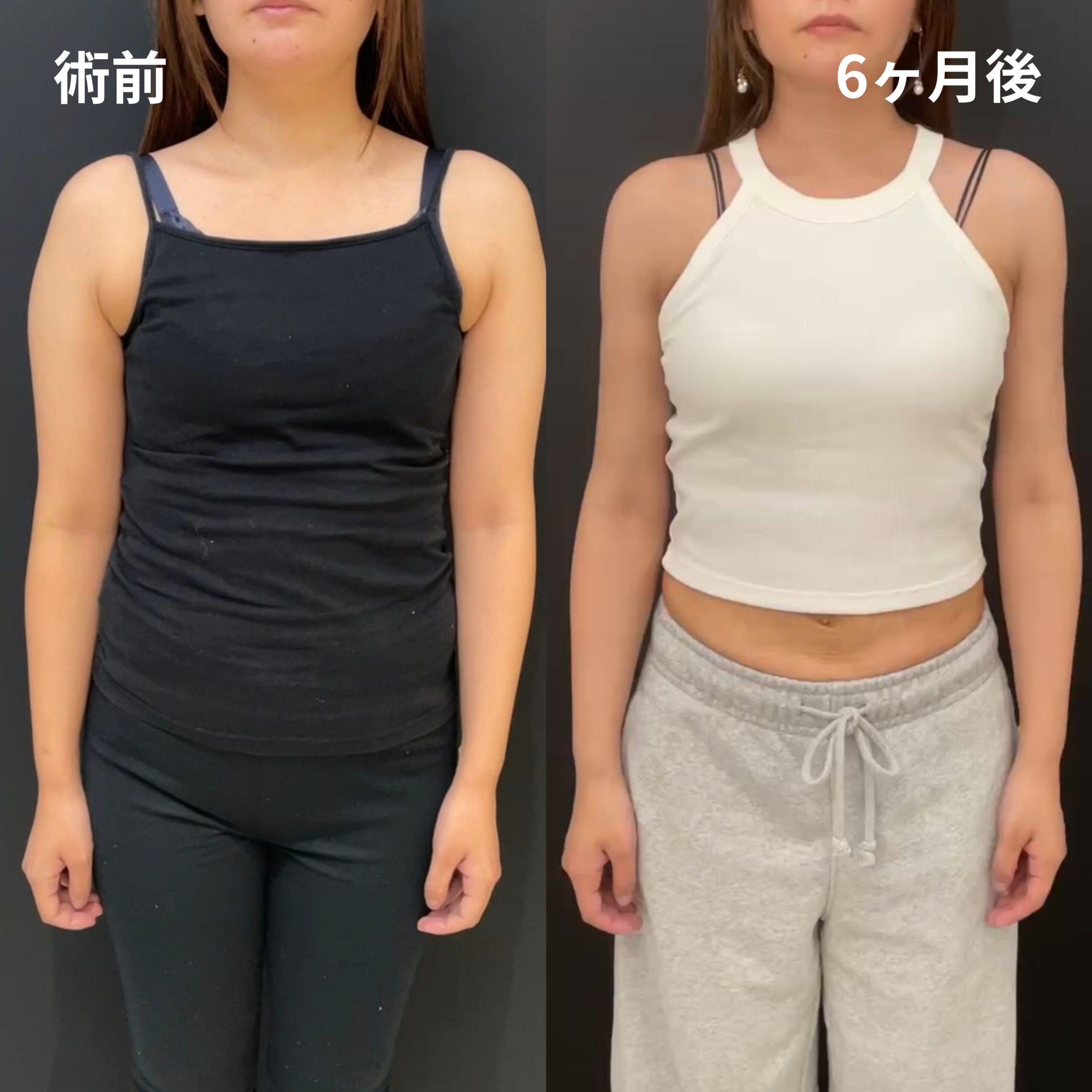 <br />
<b>Warning</b>:  Undefined variable $image_alt in <b>/home/r9092703/public_html/4dclinic.jp/wp/wp-content/themes/4d-clinic/single-case.php</b> on line <b>109</b><br />
