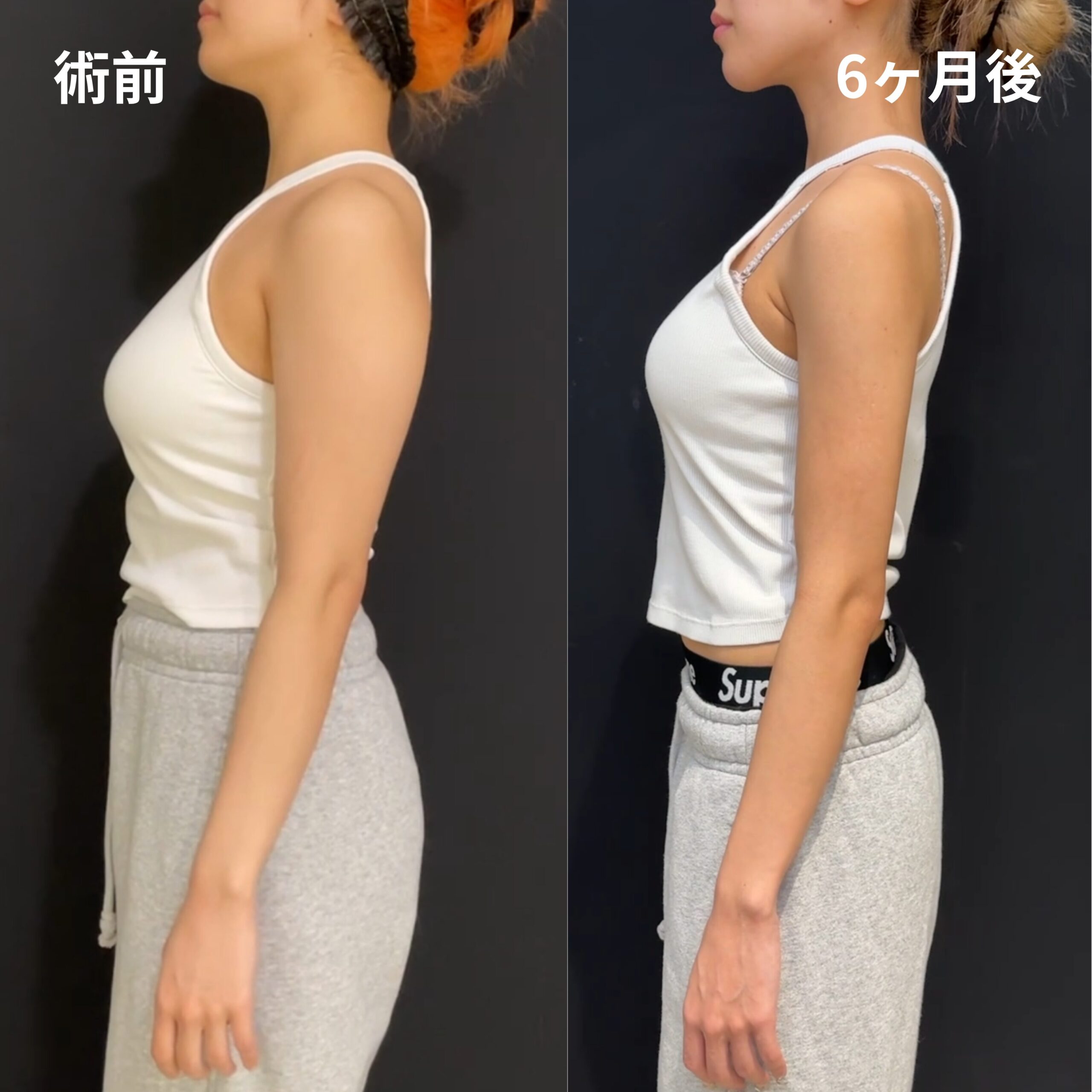 <br />
<b>Warning</b>:  Undefined variable $image_alt in <b>/home/r9092703/public_html/4dclinic.jp/wp/wp-content/themes/4d-clinic/single-case.php</b> on line <b>109</b><br />
