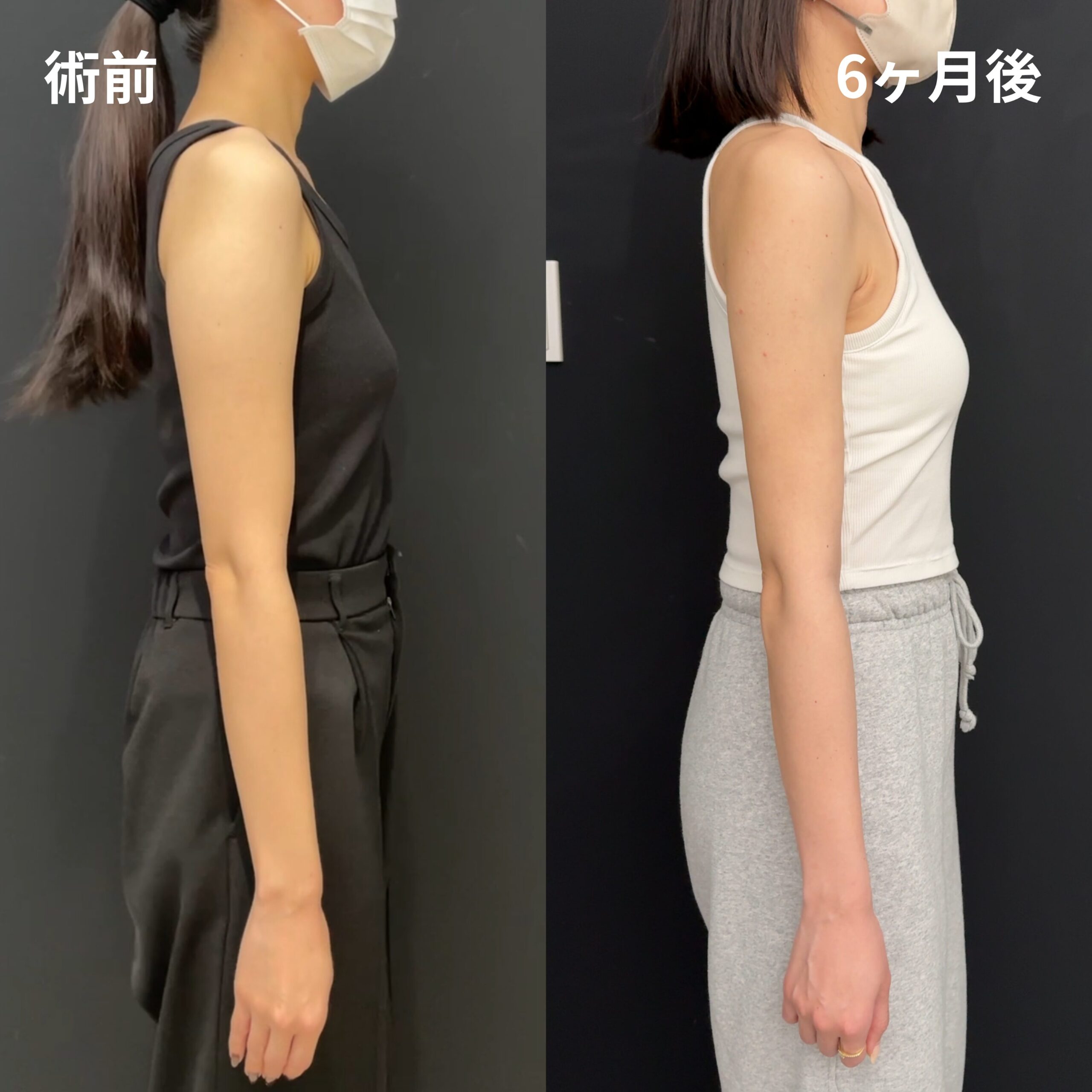 <br />
<b>Warning</b>:  Undefined variable $image_alt in <b>/home/r9092703/public_html/4dclinic.jp/wp/wp-content/themes/4d-clinic/single-case.php</b> on line <b>109</b><br />
