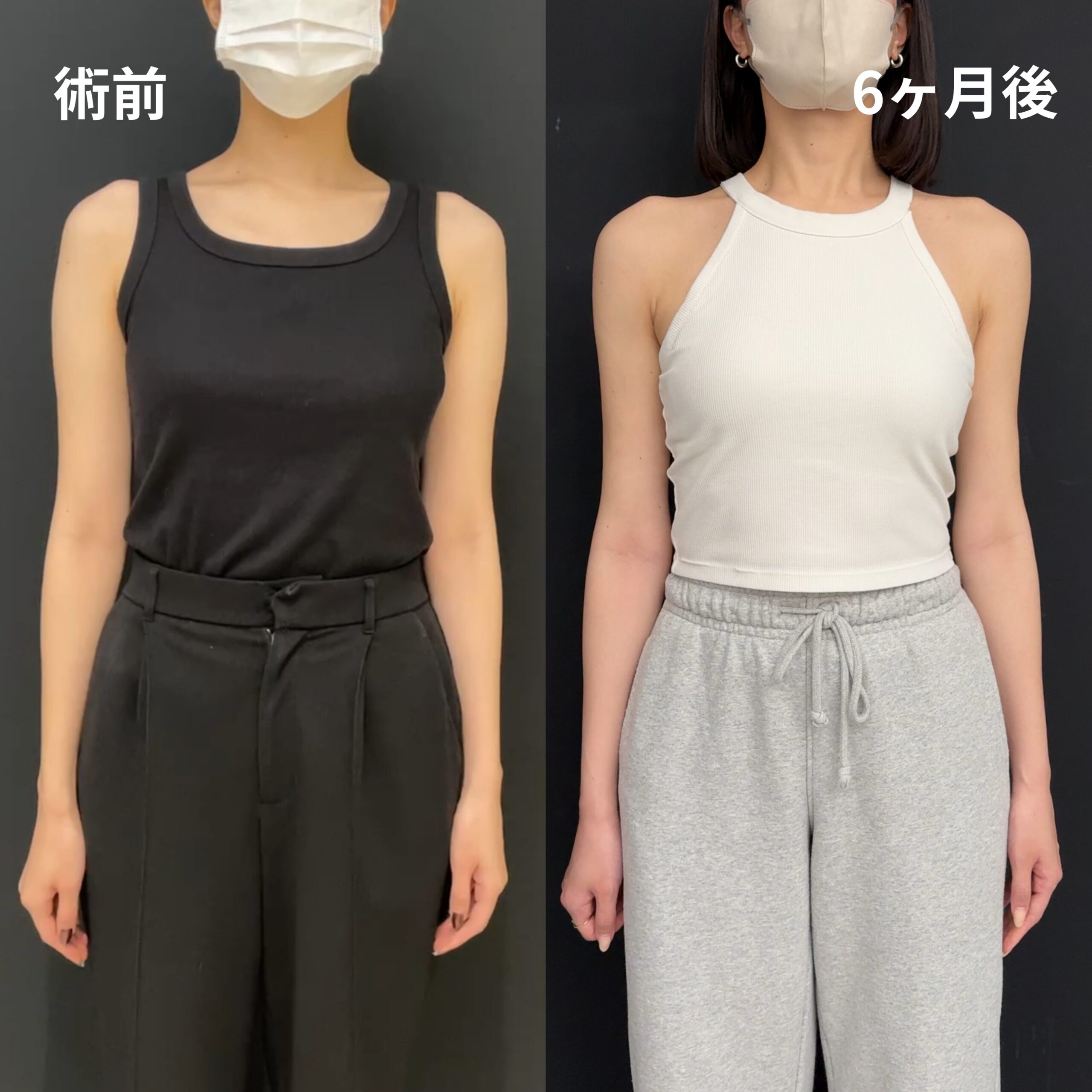 <br />
<b>Warning</b>:  Undefined variable $image_alt in <b>/home/r9092703/public_html/4dclinic.jp/wp/wp-content/themes/4d-clinic/single-case.php</b> on line <b>109</b><br />

