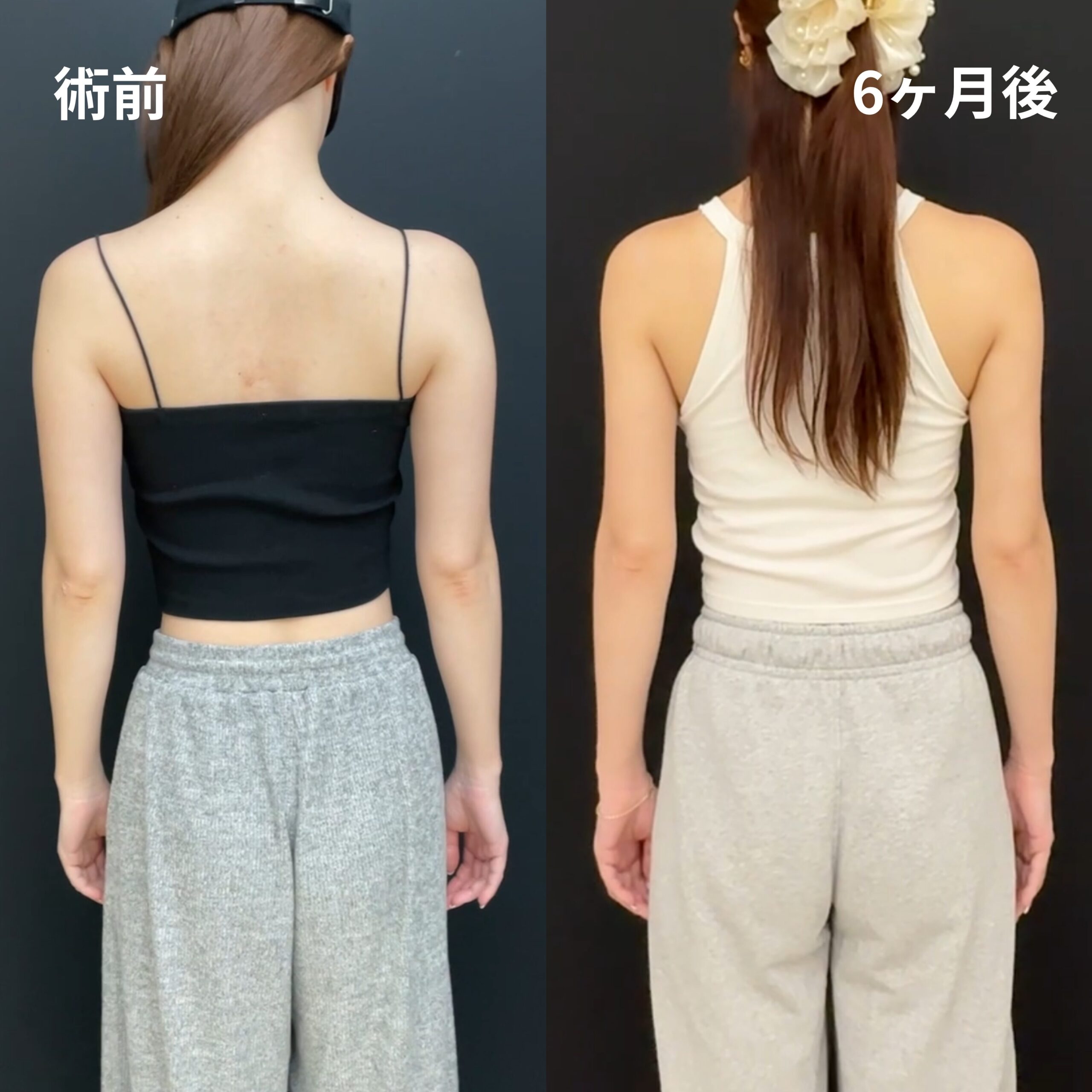 <br />
<b>Warning</b>:  Undefined variable $image_alt in <b>/home/r9092703/public_html/4dclinic.jp/wp/wp-content/themes/4d-clinic/single-case.php</b> on line <b>109</b><br />
