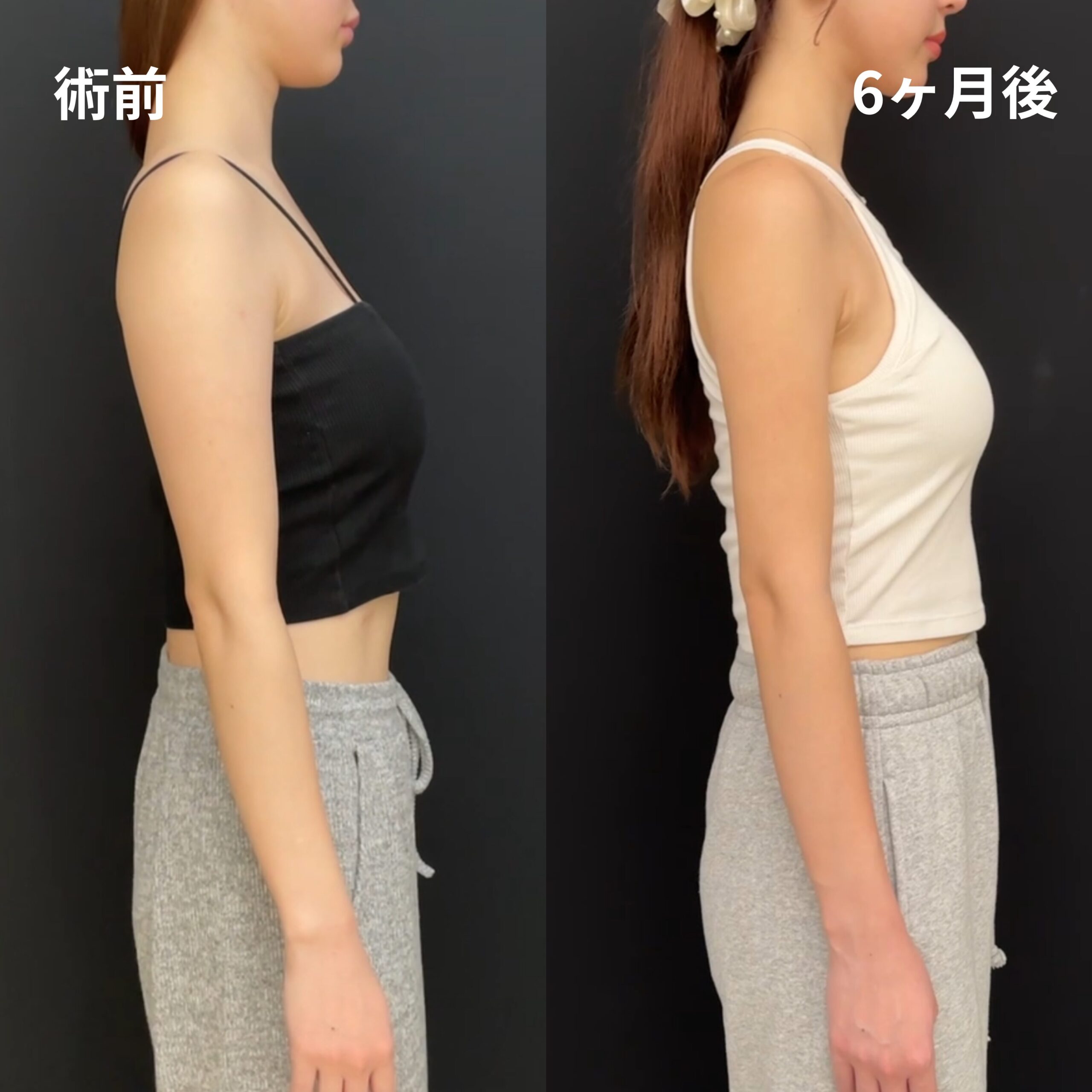 <br />
<b>Warning</b>:  Undefined variable $image_alt in <b>/home/r9092703/public_html/4dclinic.jp/wp/wp-content/themes/4d-clinic/single-case.php</b> on line <b>109</b><br />
