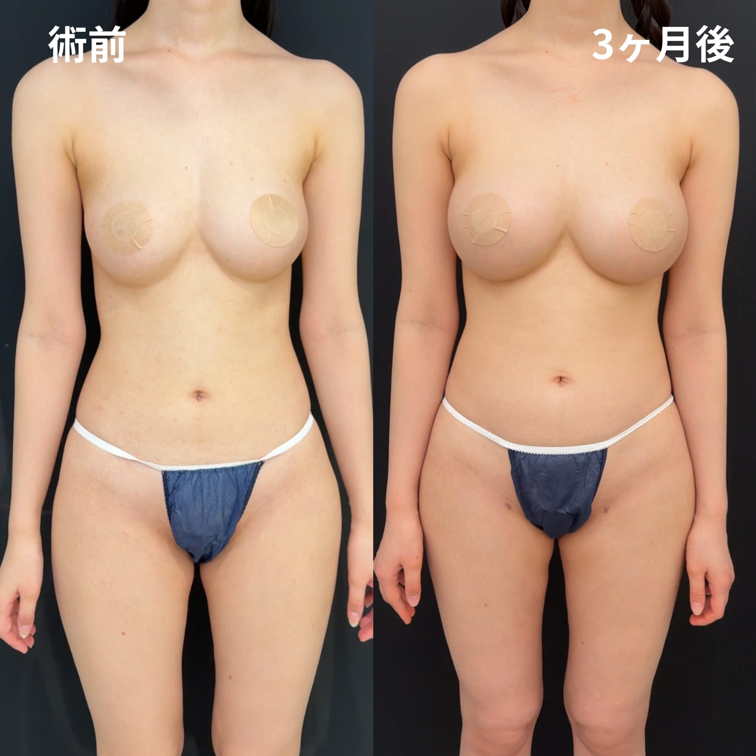 <br />
<b>Warning</b>:  Undefined variable $image_alt in <b>/home/r9092703/public_html/4dclinic.jp/wp/wp-content/themes/4d-clinic/single-case.php</b> on line <b>109</b><br />
