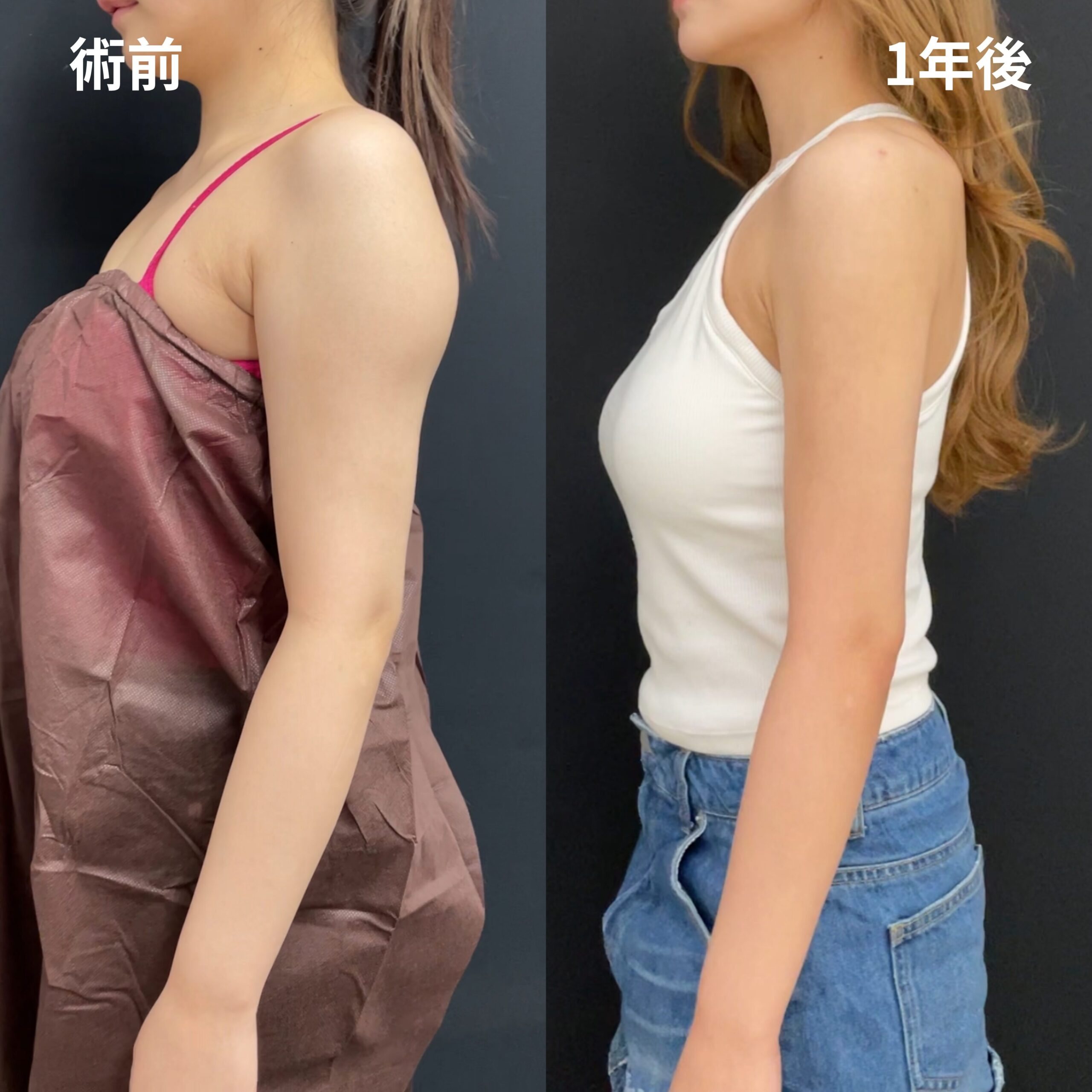 二の腕全周・肩甲骨横・副乳脇肉