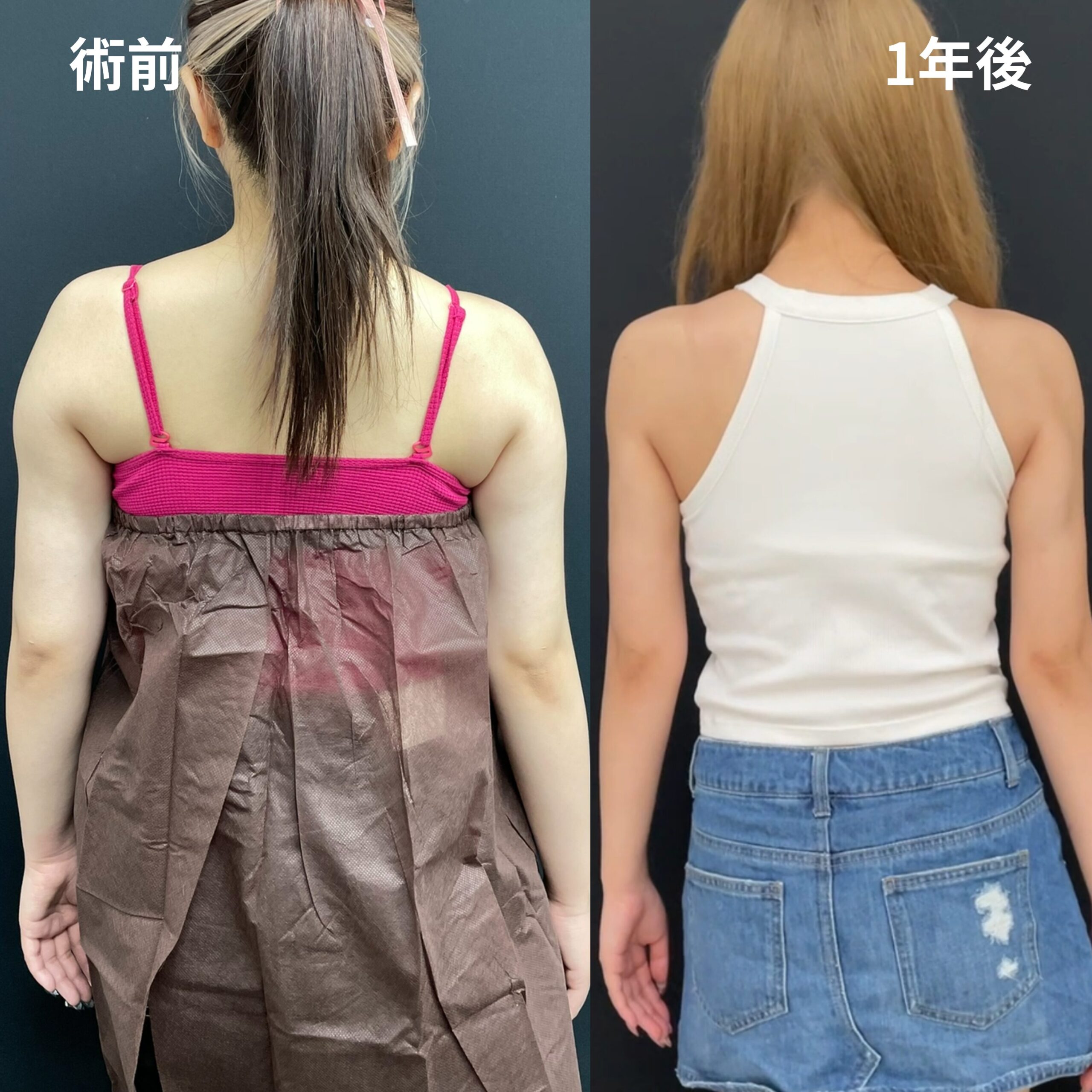 <br />
<b>Warning</b>:  Undefined variable $image_alt in <b>/home/r9092703/public_html/4dclinic.jp/wp/wp-content/themes/4d-clinic/single-case.php</b> on line <b>109</b><br />
