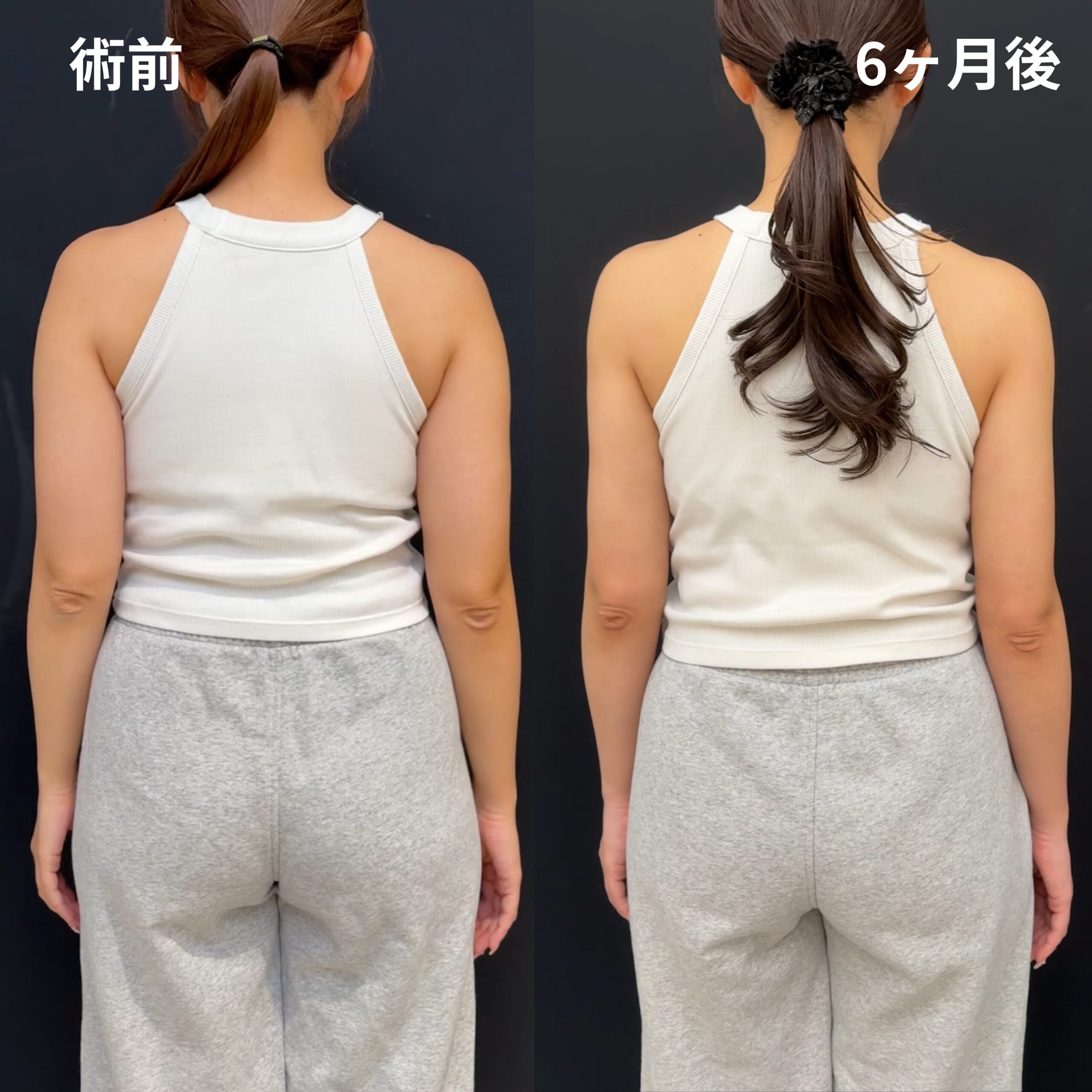 <br />
<b>Warning</b>:  Undefined variable $image_alt in <b>/home/r9092703/public_html/4dclinic.jp/wp/wp-content/themes/4d-clinic/single-case.php</b> on line <b>109</b><br />
