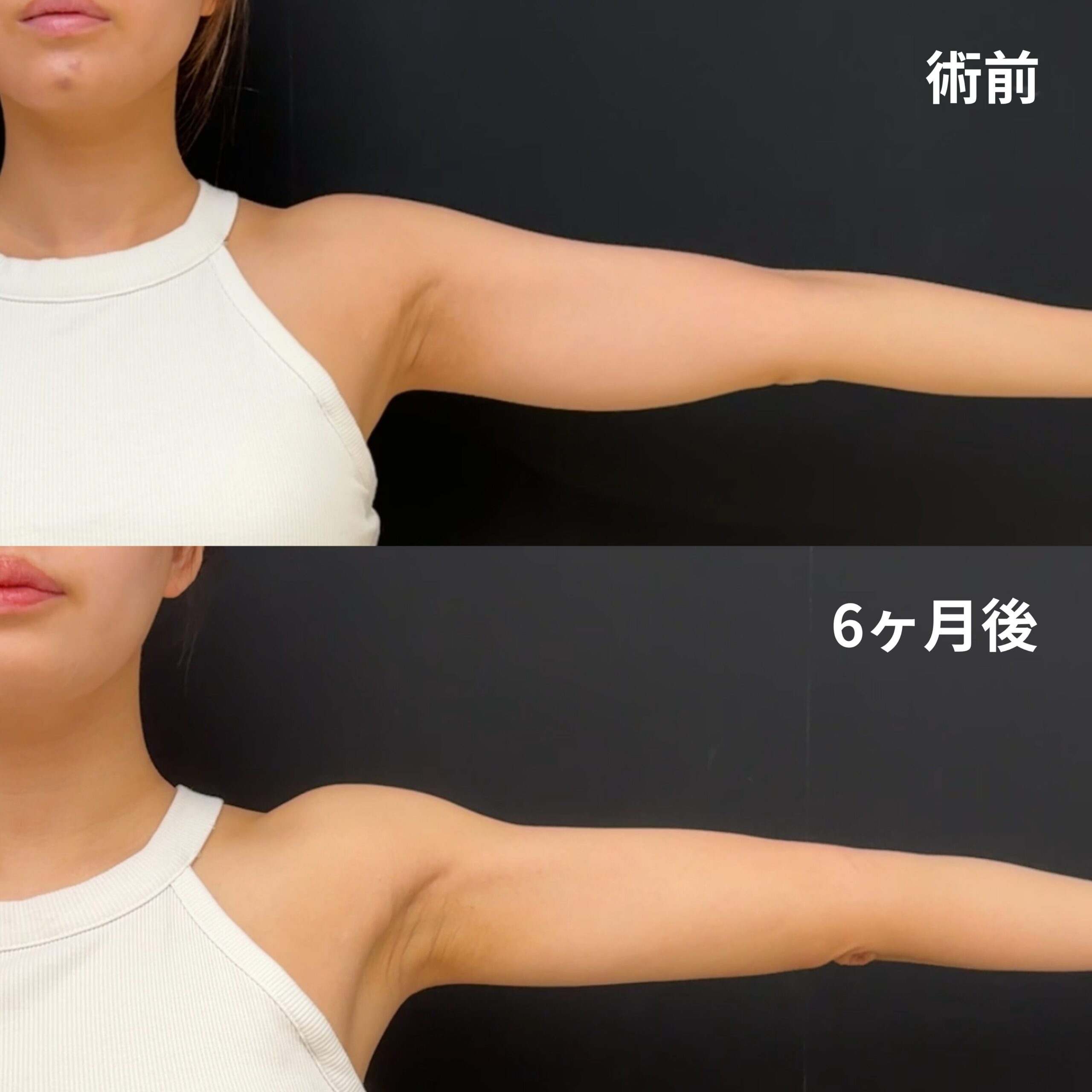 <br />
<b>Warning</b>:  Undefined variable $image_alt in <b>/home/r9092703/public_html/4dclinic.jp/wp/wp-content/themes/4d-clinic/single-case.php</b> on line <b>109</b><br />
