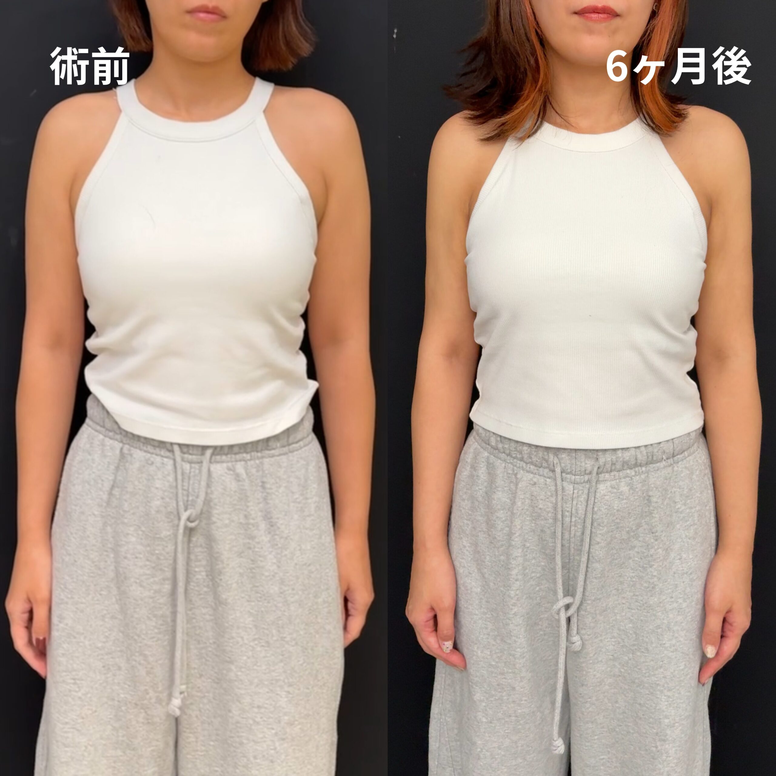 <br />
<b>Warning</b>:  Undefined variable $image_alt in <b>/home/r9092703/public_html/4dclinic.jp/wp/wp-content/themes/4d-clinic/single-case.php</b> on line <b>109</b><br />
