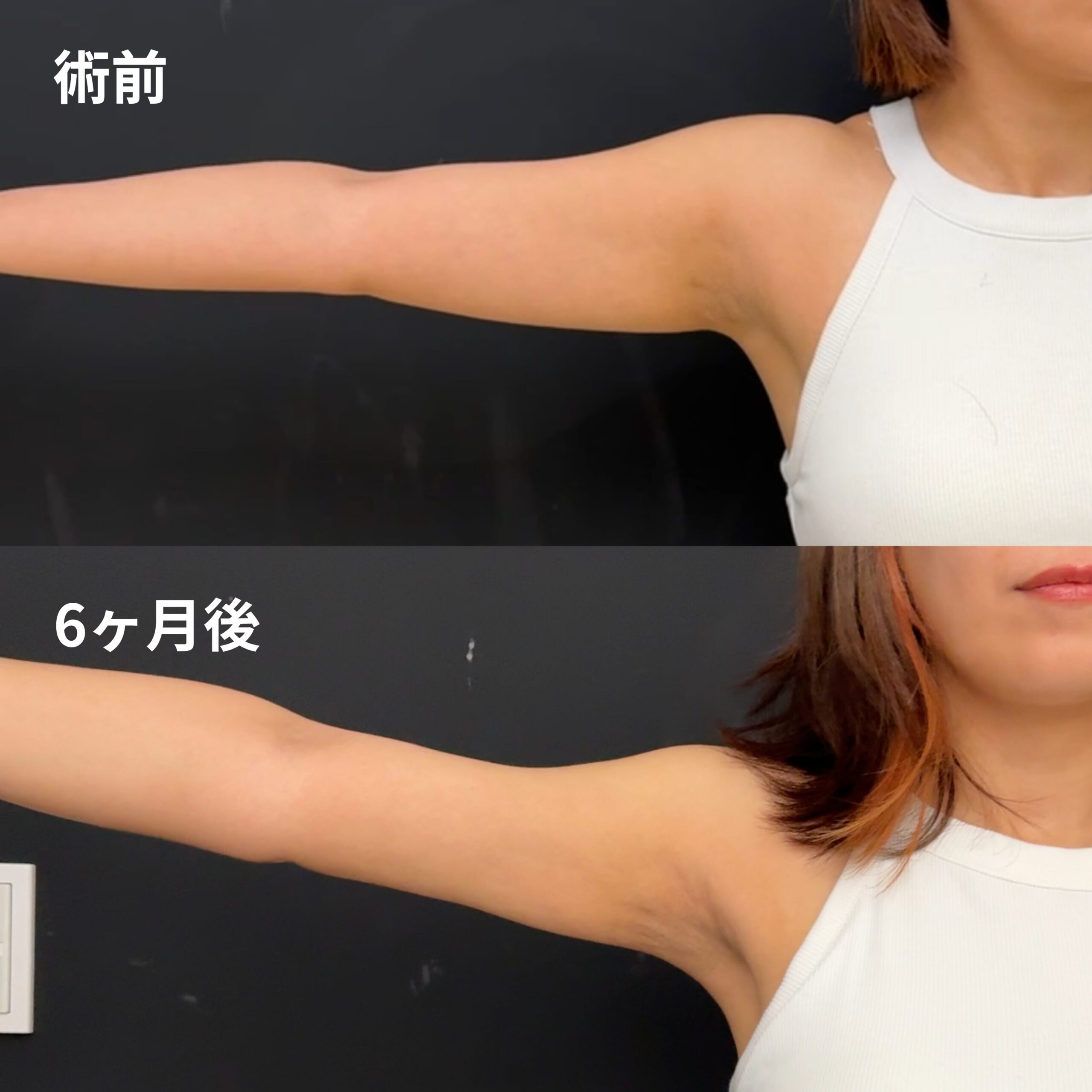 <br />
<b>Warning</b>:  Undefined variable $image_alt in <b>/home/r9092703/public_html/4dclinic.jp/wp/wp-content/themes/4d-clinic/single-case.php</b> on line <b>109</b><br />
