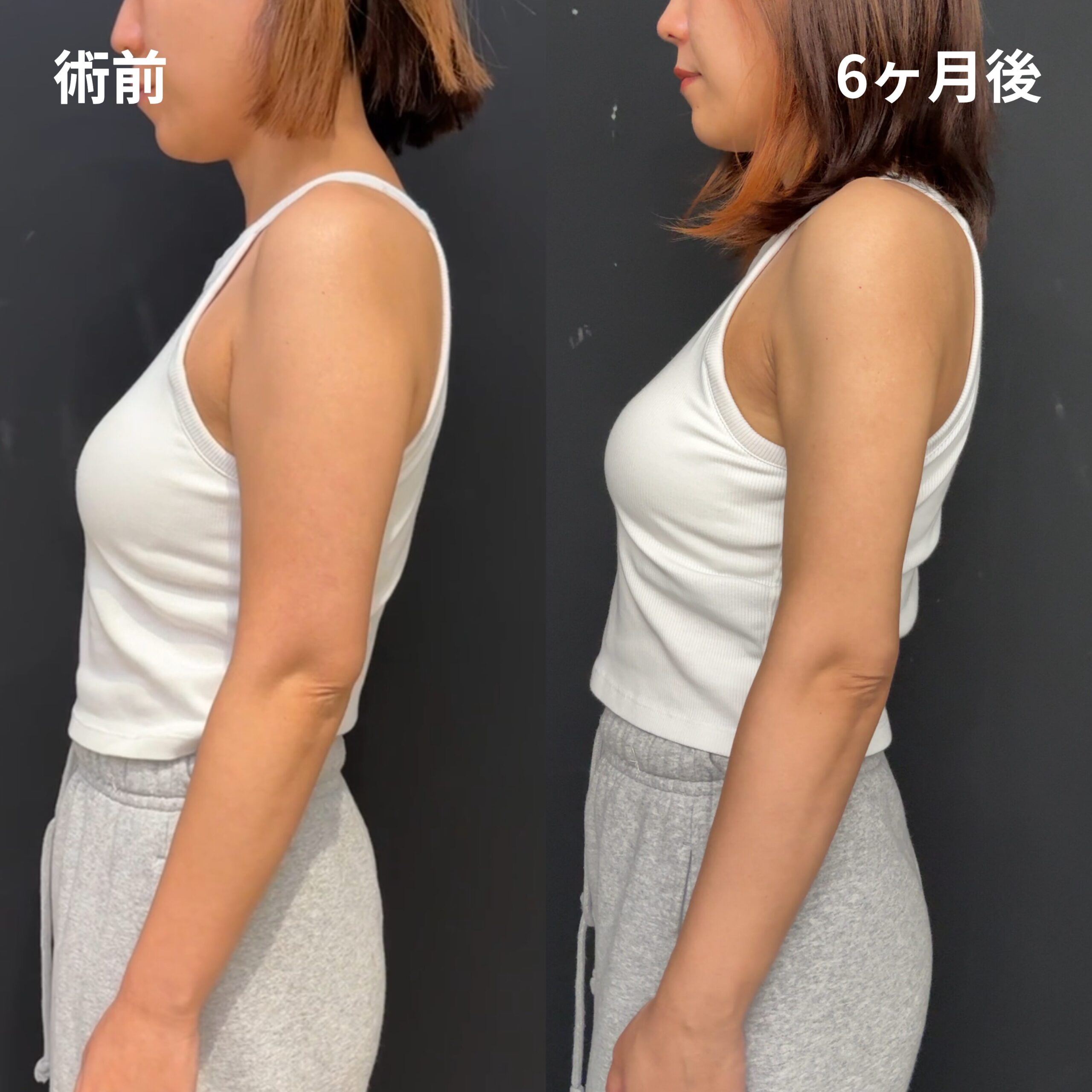 二の腕全周・肩・肩甲骨横・脇肉副乳・ブラ上下・エンブレイスRF（二の腕・肩）