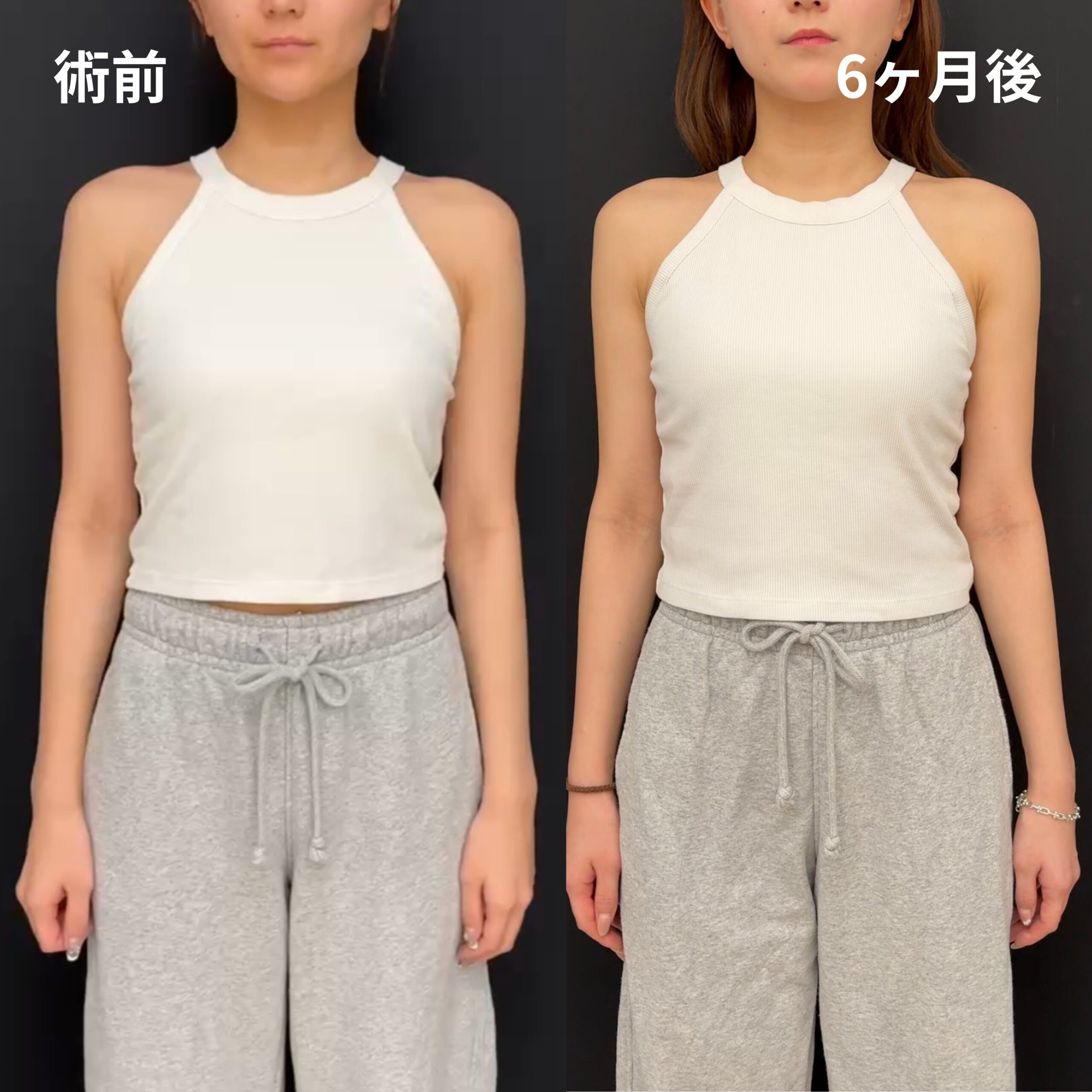 <br />
<b>Warning</b>:  Undefined variable $image_alt in <b>/home/r9092703/public_html/4dclinic.jp/wp/wp-content/themes/4d-clinic/single-case.php</b> on line <b>109</b><br />
