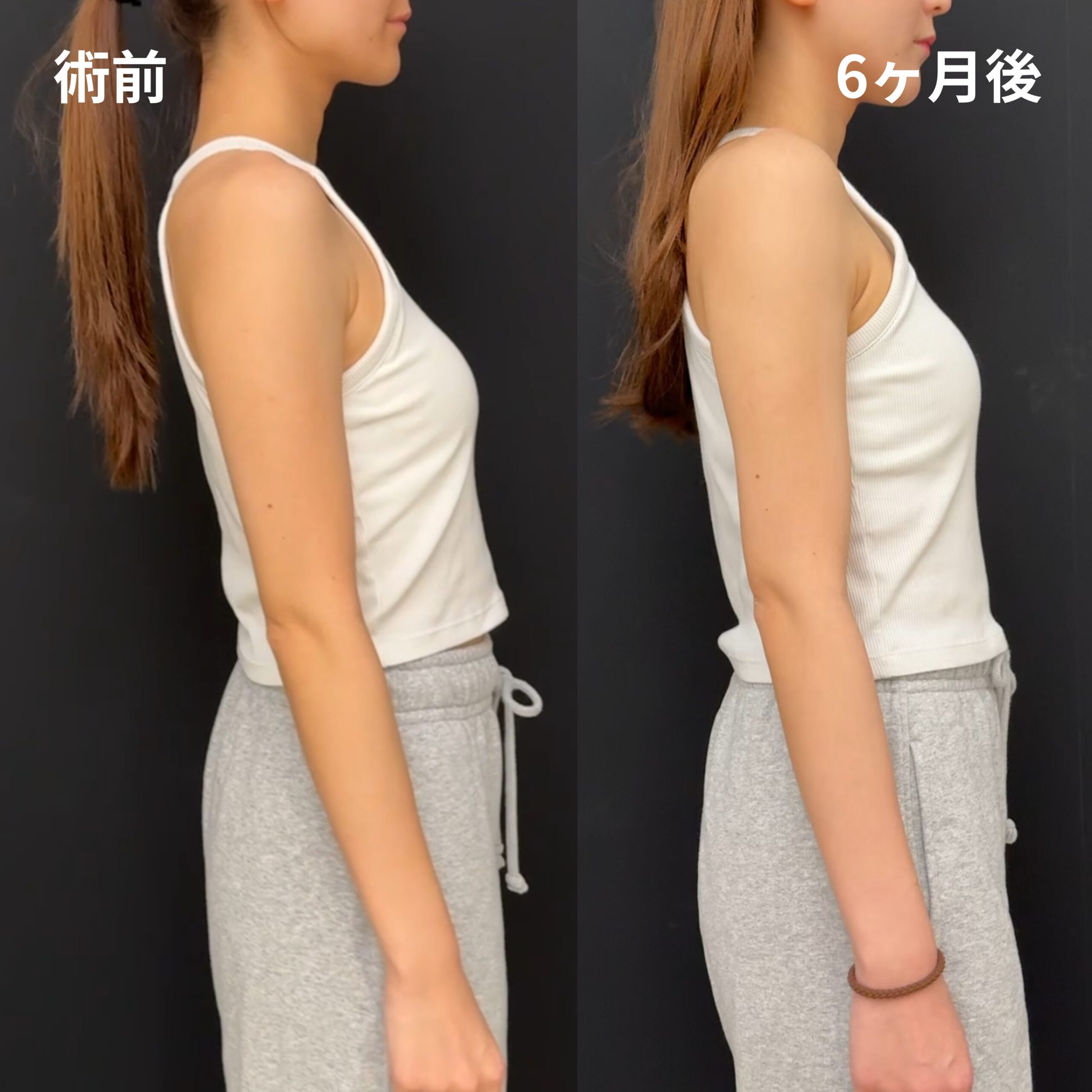 <br />
<b>Warning</b>:  Undefined variable $image_alt in <b>/home/r9092703/public_html/4dclinic.jp/wp/wp-content/themes/4d-clinic/single-case.php</b> on line <b>109</b><br />
