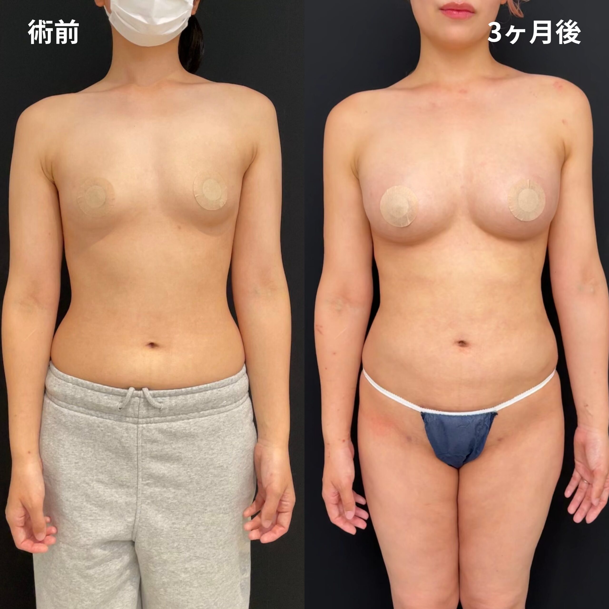 <br />
<b>Warning</b>:  Undefined variable $image_alt in <b>/home/r9092703/public_html/4dclinic.jp/wp/wp-content/themes/4d-clinic/single-case.php</b> on line <b>109</b><br />
