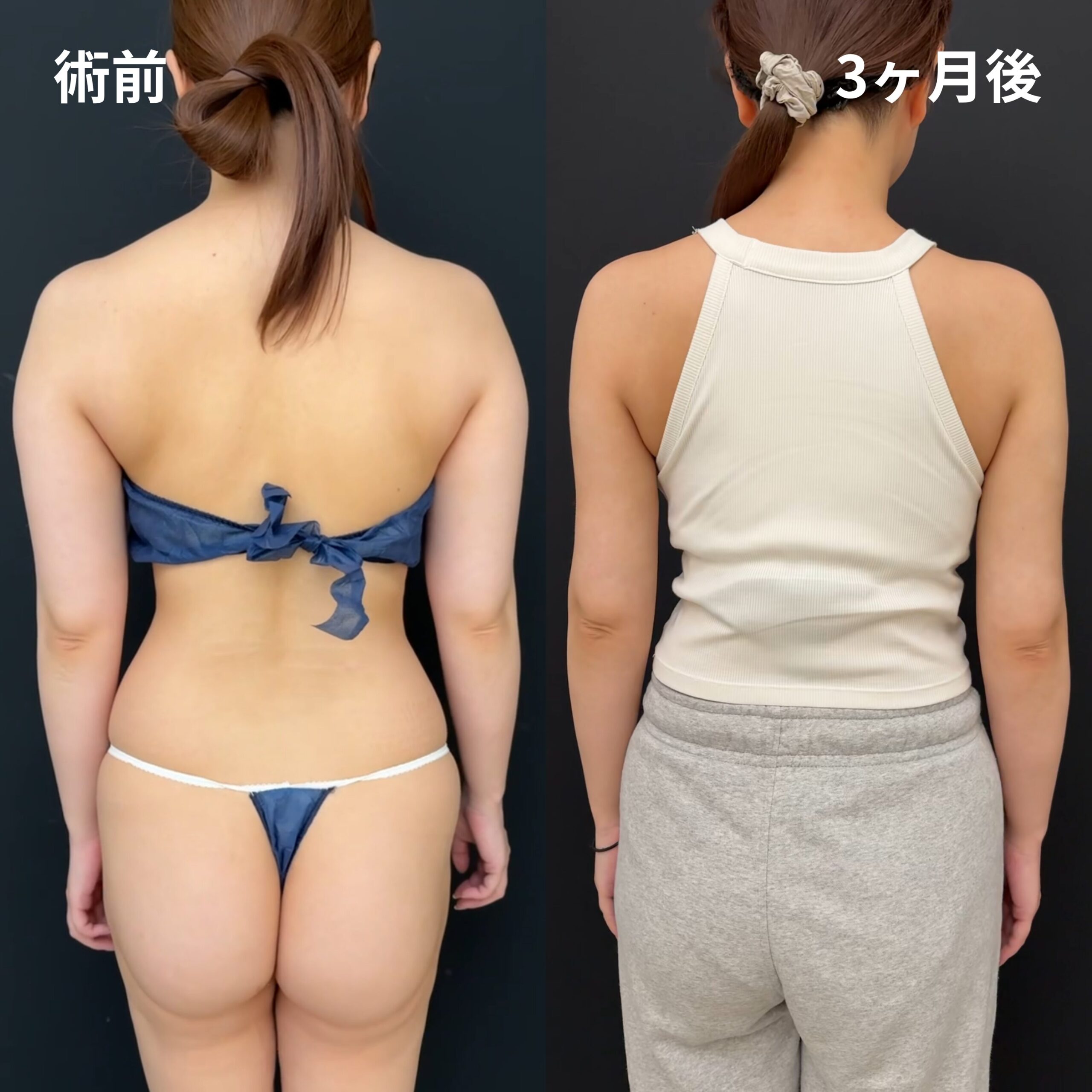 <br />
<b>Warning</b>:  Undefined variable $image_alt in <b>/home/r9092703/public_html/4dclinic.jp/wp/wp-content/themes/4d-clinic/single-case.php</b> on line <b>109</b><br />
