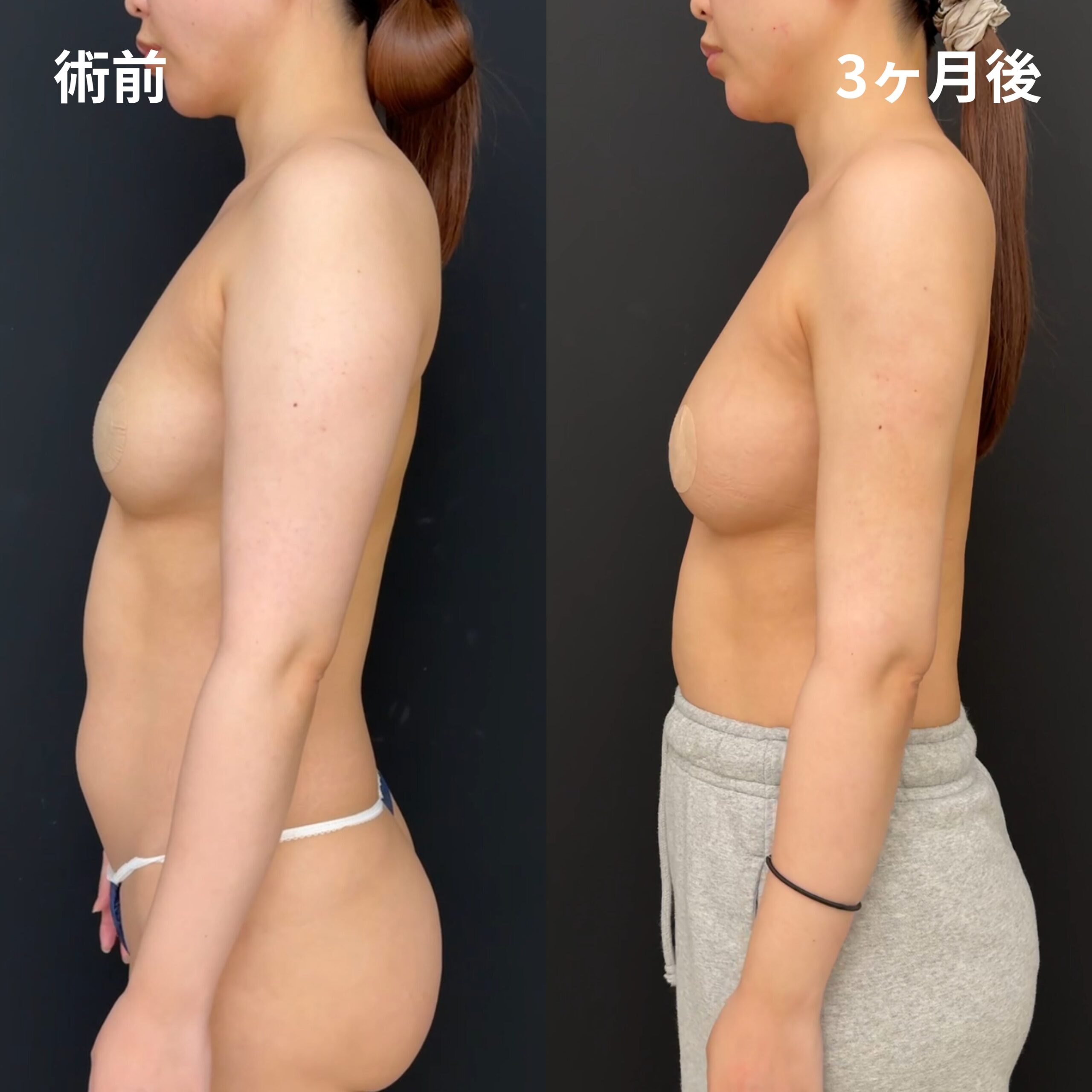 <br />
<b>Warning</b>:  Undefined variable $image_alt in <b>/home/r9092703/public_html/4dclinic.jp/wp/wp-content/themes/4d-clinic/single-case.php</b> on line <b>109</b><br />
