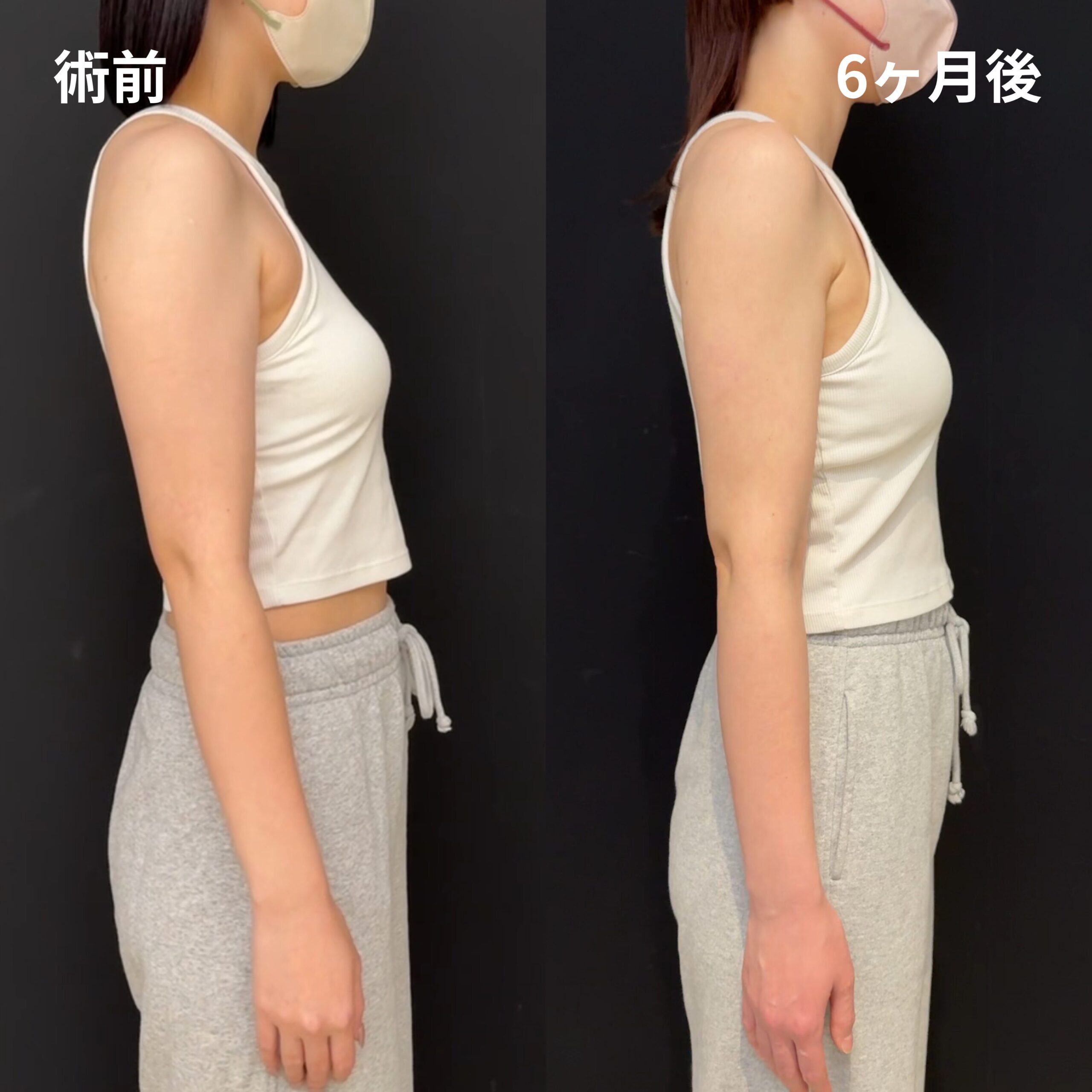 二の腕全周・肩・肩甲骨横・脇肉副乳
