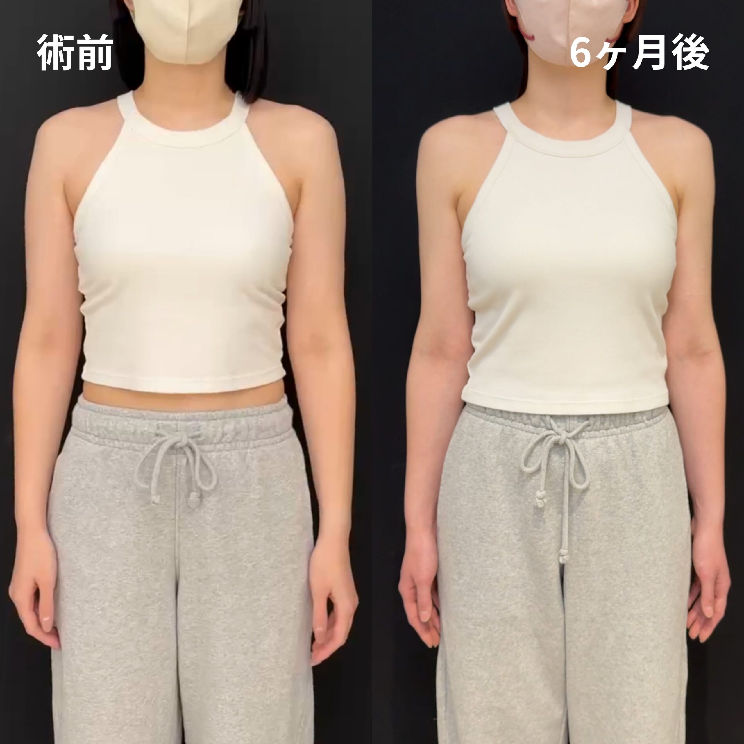 <br />
<b>Warning</b>:  Undefined variable $image_alt in <b>/home/r9092703/public_html/4dclinic.jp/wp/wp-content/themes/4d-clinic/single-case.php</b> on line <b>109</b><br />
