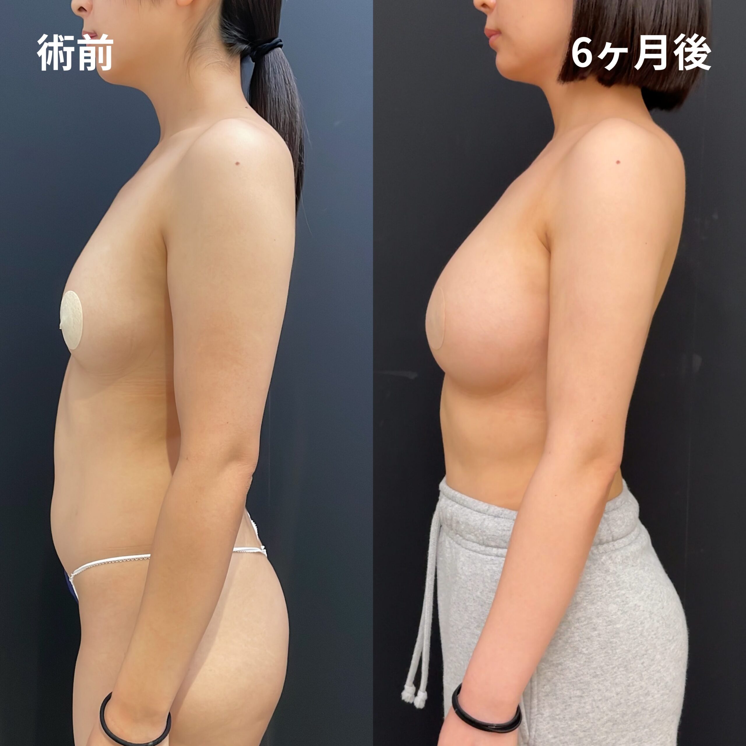 <br />
<b>Warning</b>:  Undefined variable $image_alt in <b>/home/r9092703/public_html/4dclinic.jp/wp/wp-content/themes/4d-clinic/single-case.php</b> on line <b>109</b><br />
