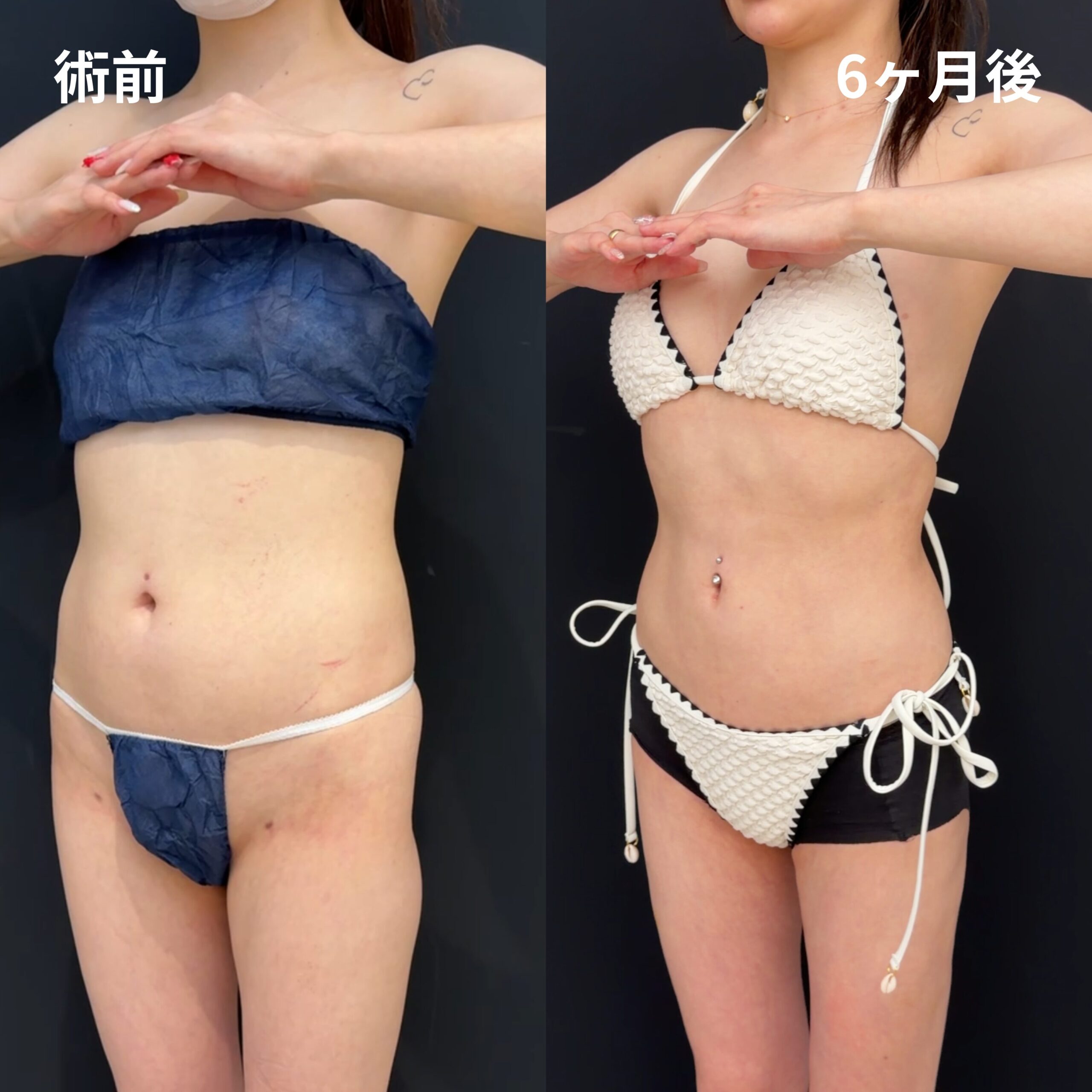<br />
<b>Warning</b>:  Undefined variable $image_alt in <b>/home/r9092703/public_html/4dclinic.jp/wp/wp-content/themes/4d-clinic/single-case.php</b> on line <b>109</b><br />
