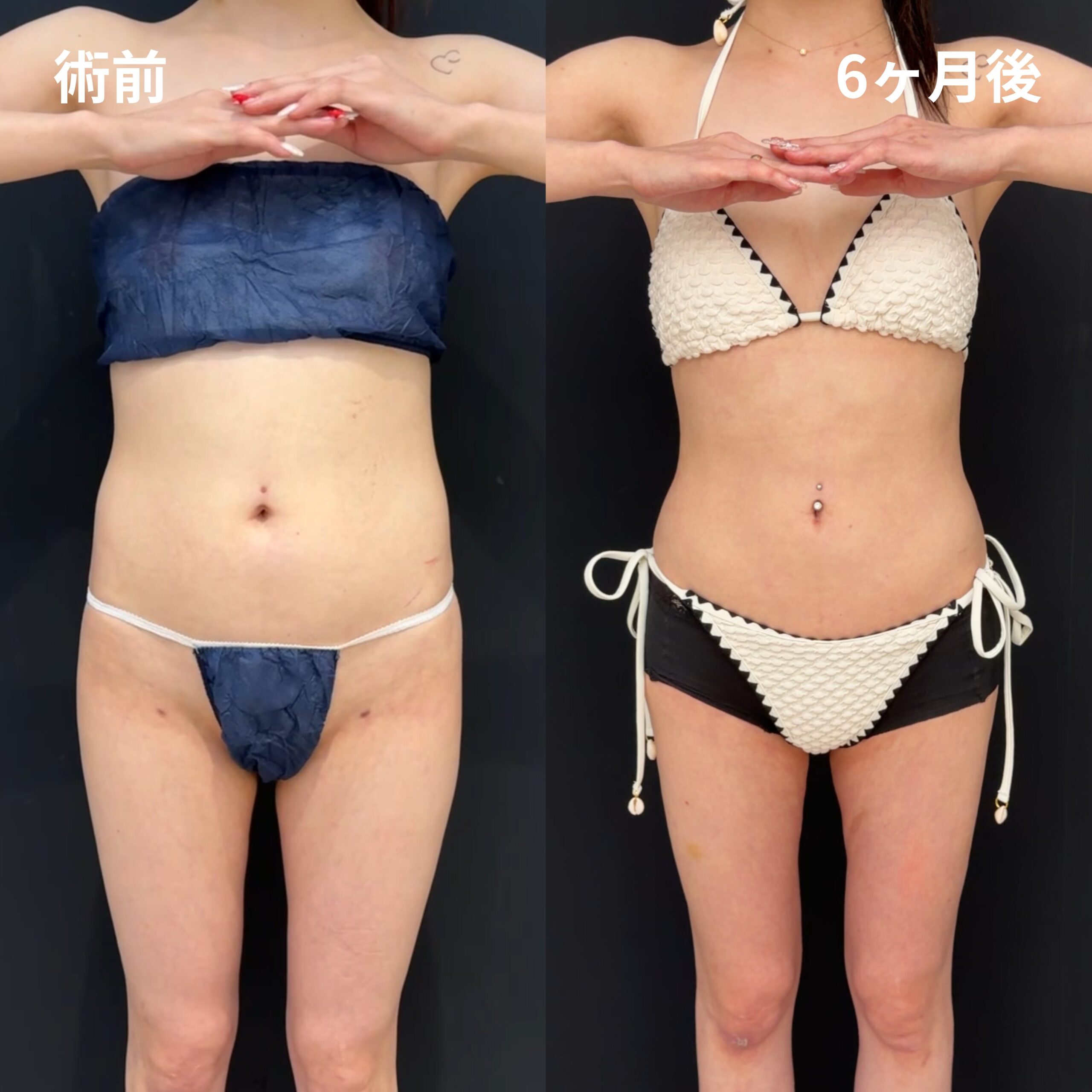 腹部全周