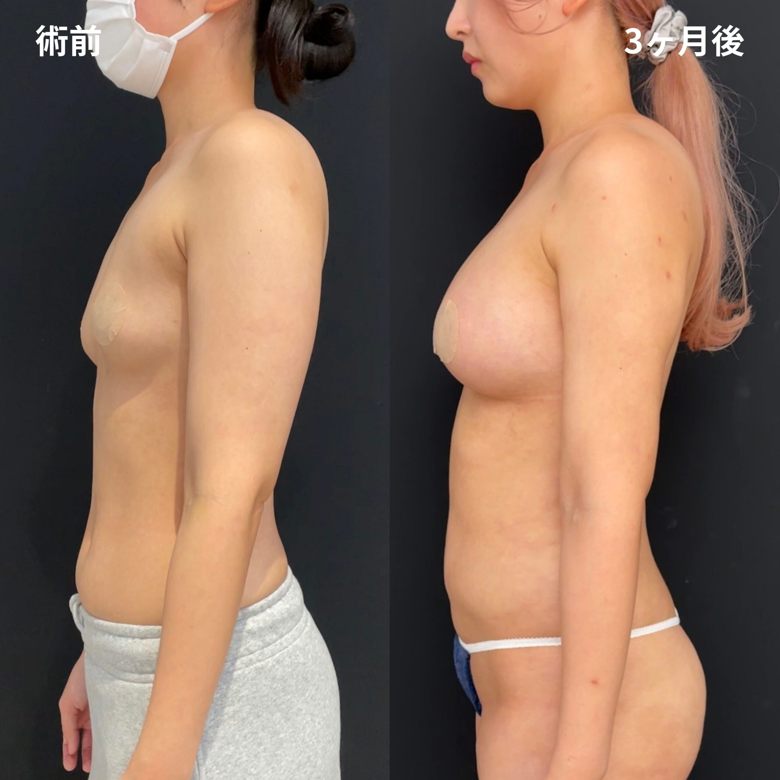 <br />
<b>Warning</b>:  Undefined variable $image_alt in <b>/home/r9092703/public_html/4dclinic.jp/wp/wp-content/themes/4d-clinic/single-case.php</b> on line <b>109</b><br />
