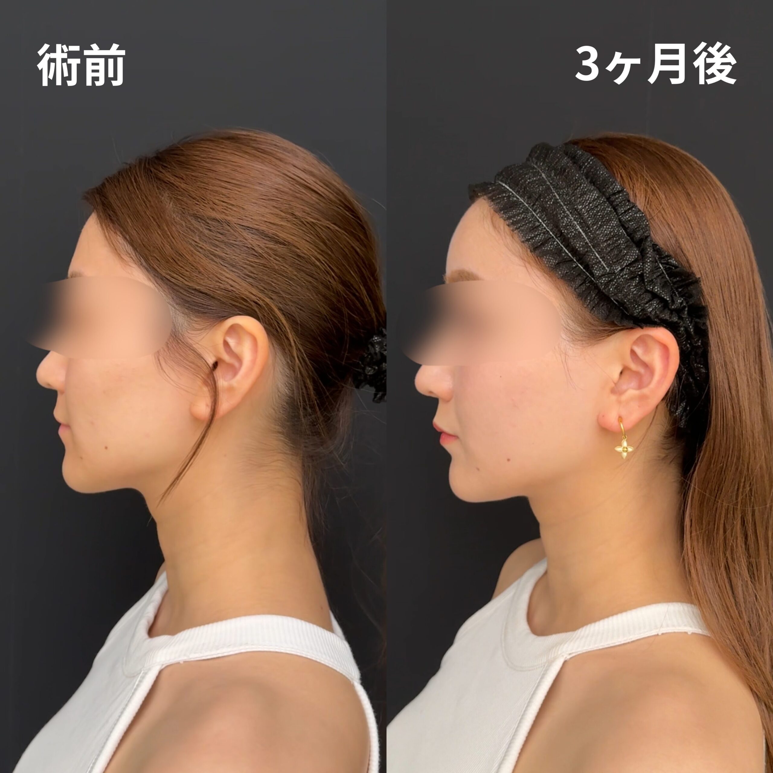 <br />
<b>Warning</b>:  Undefined variable $image_alt in <b>/home/r9092703/public_html/4dclinic.jp/wp/wp-content/themes/4d-clinic/single-case.php</b> on line <b>109</b><br />
