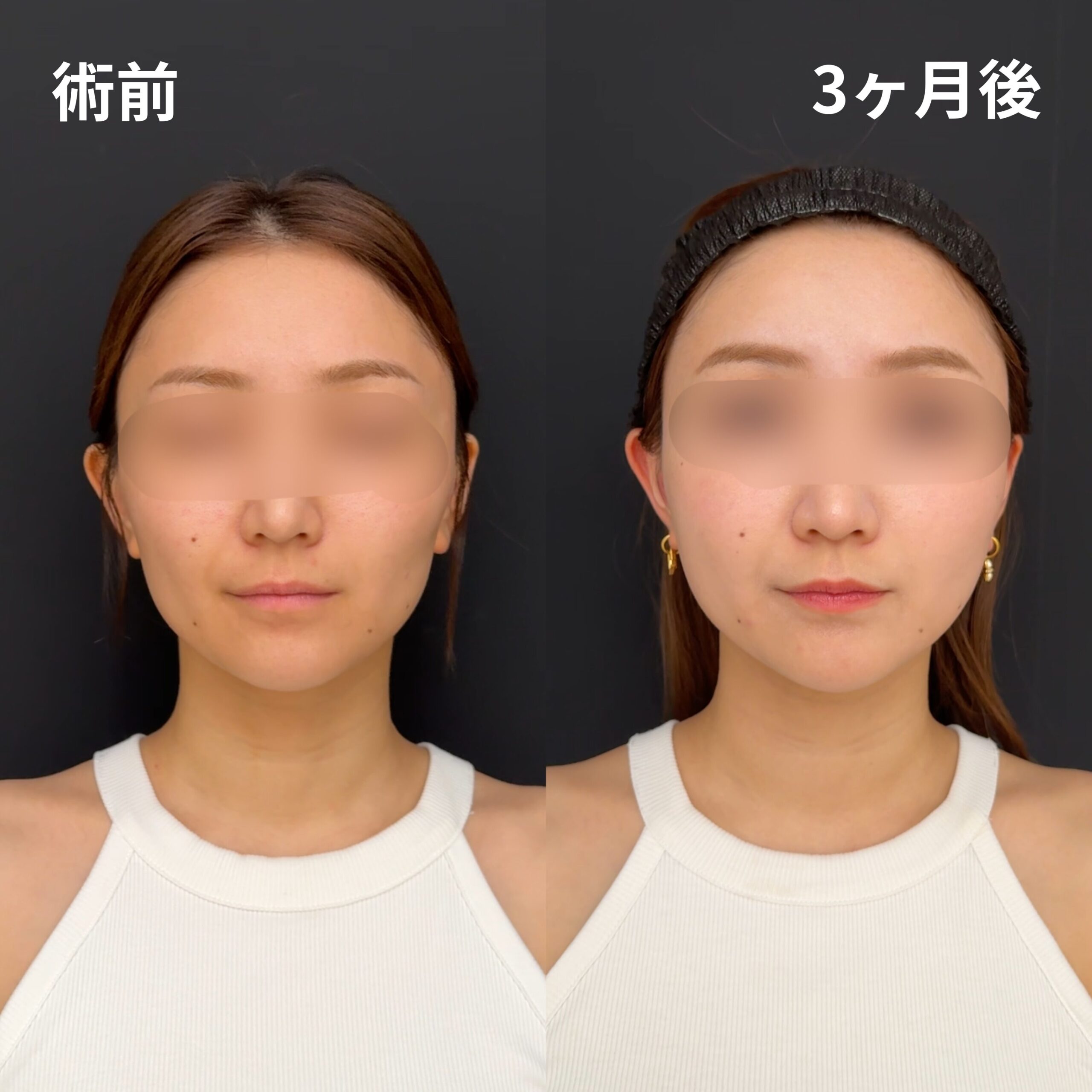 <br />
<b>Warning</b>:  Undefined variable $image_alt in <b>/home/r9092703/public_html/4dclinic.jp/wp/wp-content/themes/4d-clinic/single-case.php</b> on line <b>109</b><br />
