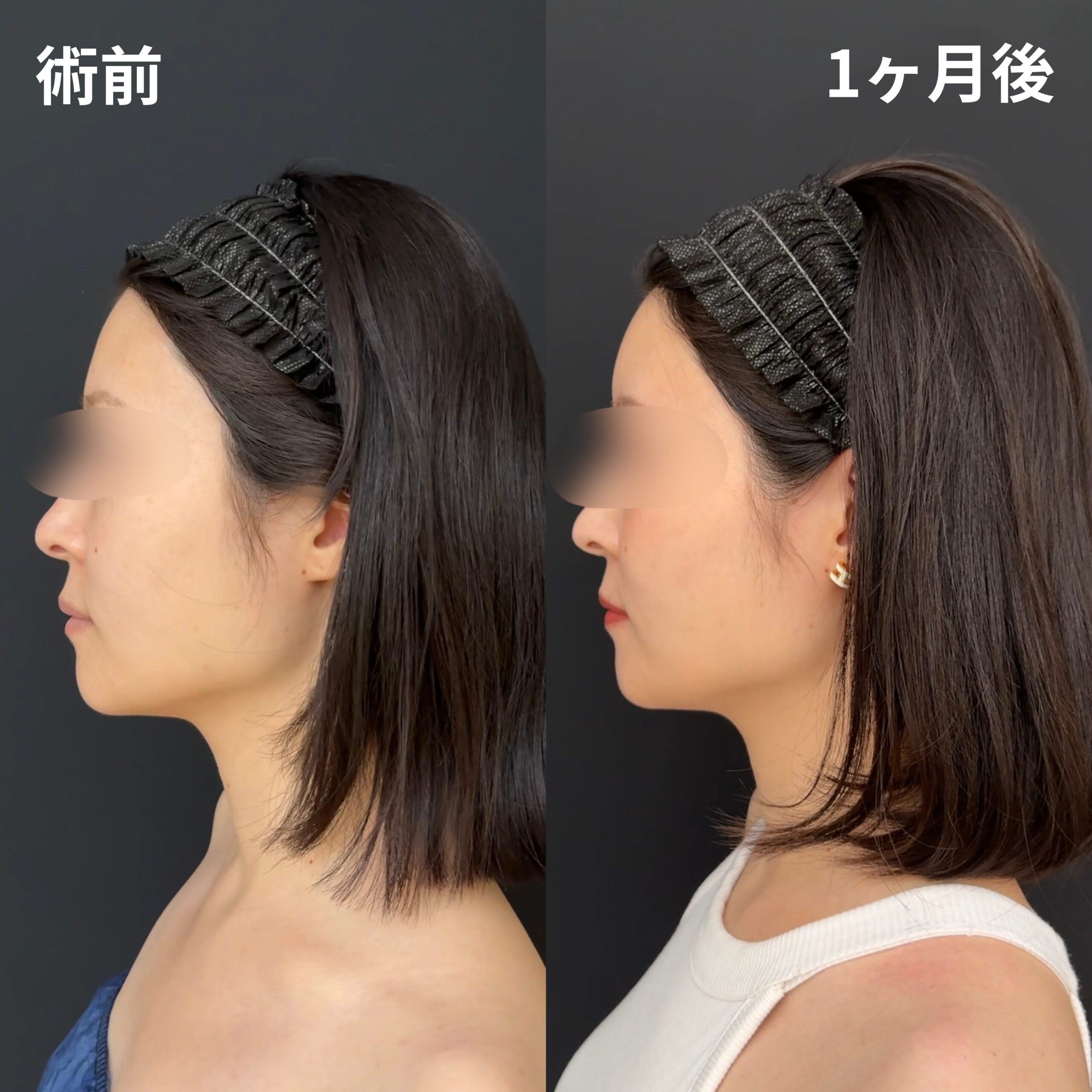 <br />
<b>Warning</b>:  Undefined variable $image_alt in <b>/home/r9092703/public_html/4dclinic.jp/wp/wp-content/themes/4d-clinic/single-case.php</b> on line <b>109</b><br />
