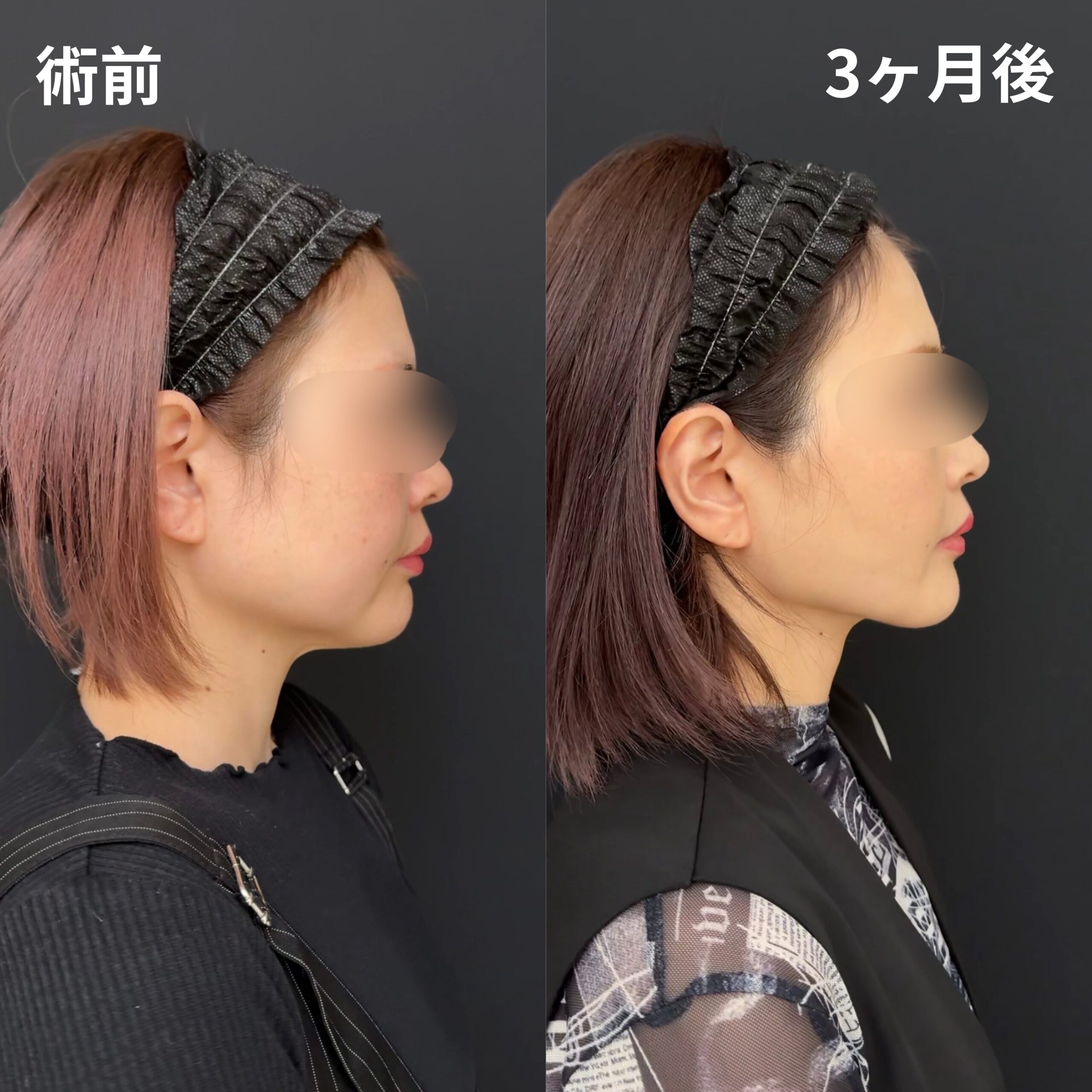 ほほ・あご下・糸リフト